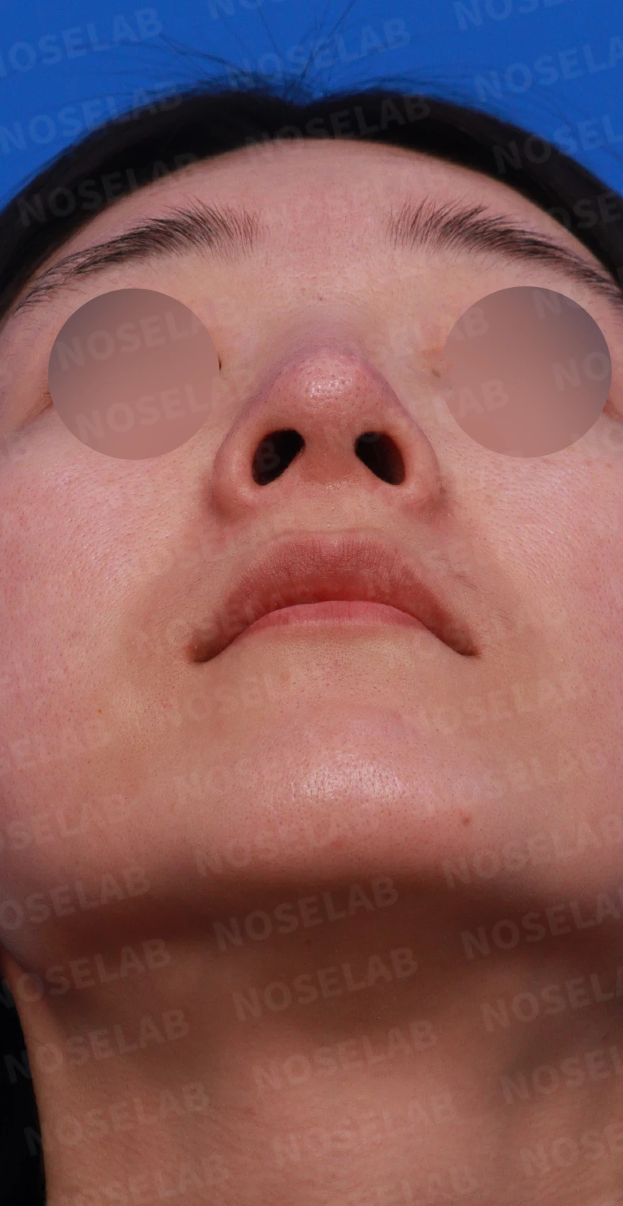 외측절골 후 코막힘과 비대칭을 살펴보는 교정 방법 — 디자인 상담 우측 측면, 비스듬한 측면, 비공 사진