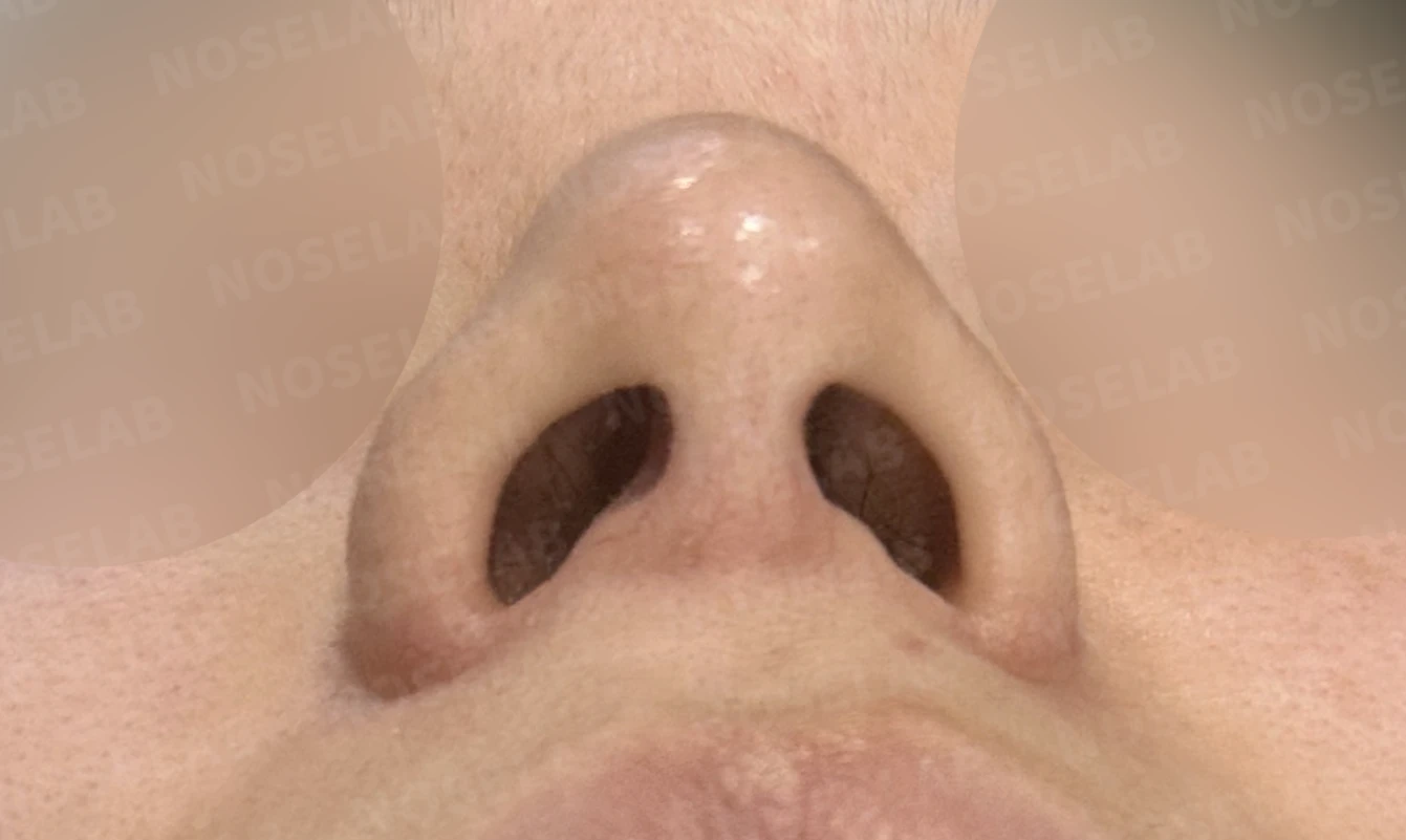 한쪽 비골이 함몰되면 왜 코가 휘어 보이는가, 절골 복원과 비중격 재건 — 수술 전 / 수술 직후 0일 직후 사진은 부기가 있는 상태로 최종 결과와 다를 수 있습니다.