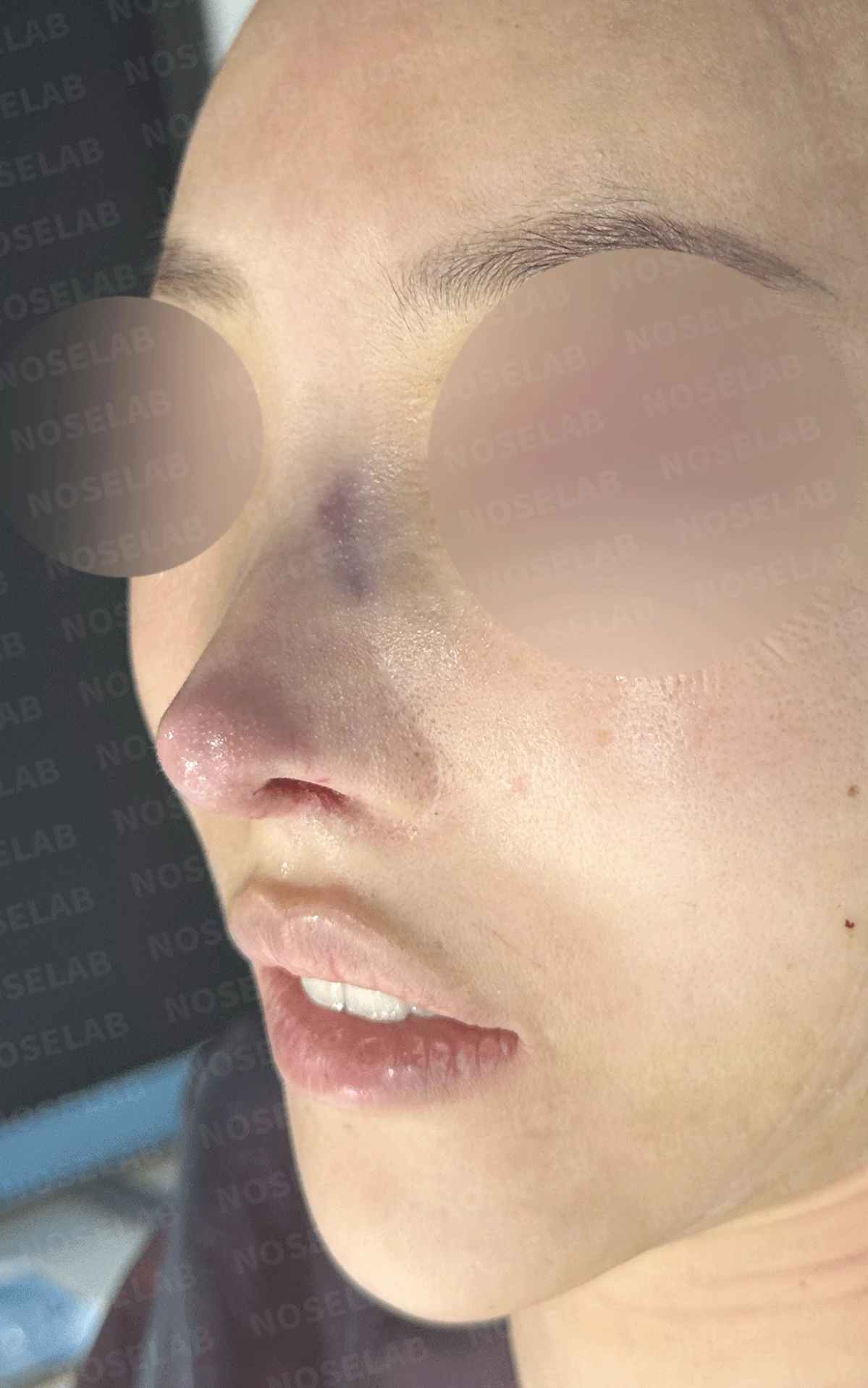 14년간 7차례 수술 후 비중격천공과 복잡한 코끝 문제 해결 - 자가늑연골 재건 실제 후기 — 본문 사진 16