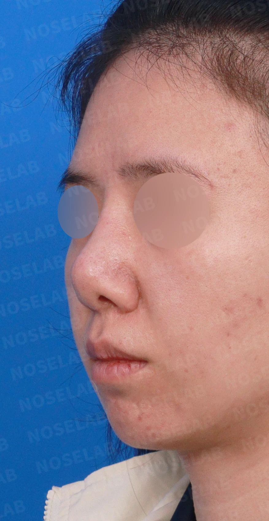 이전 수술 뒤 코가 딱딱해지고 짧아지는 구축, 왜 생기고 어떻게 재건하나 — 디자인 상담 정면, 좌측 측면, 비스듬한 측면 사진입니다.