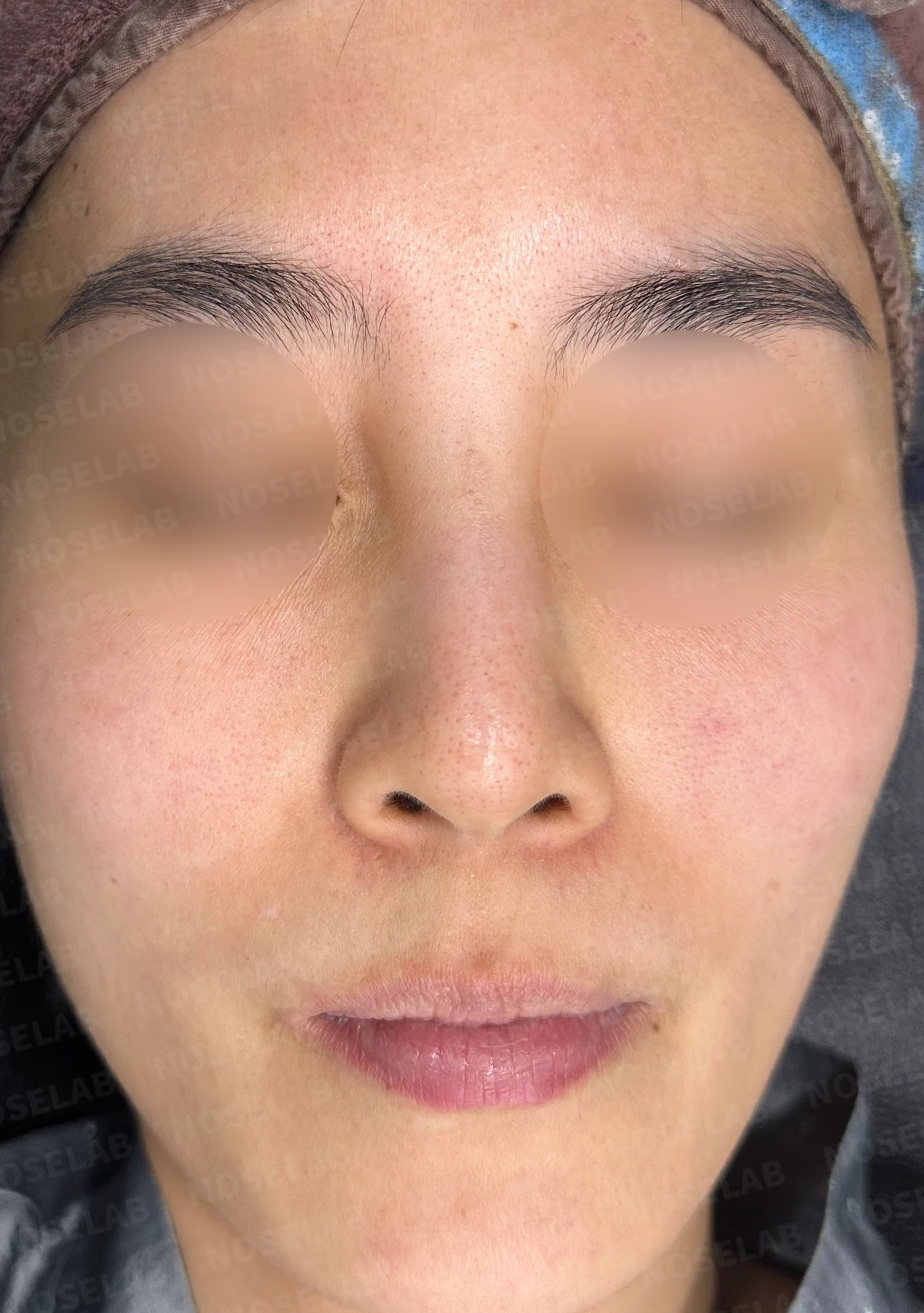 여러 차례 받은 코필러가 남긴 퍼진 코와 코막힘, 어떻게 정리하나 — 수술 전 / 수술 직후 0일 직후 사진은 부기가 있는 상태로 최종 결과와 다를 수 있습니다.