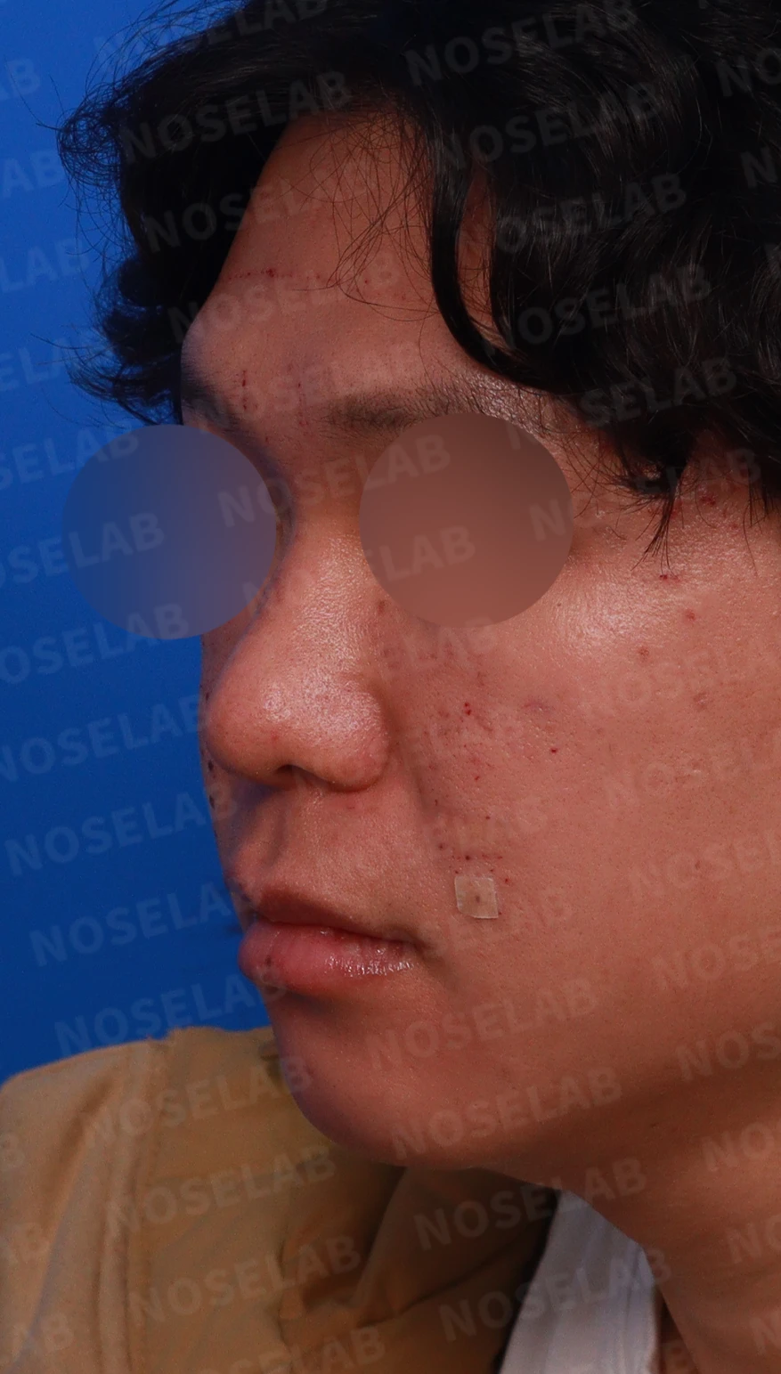얼굴 비율을 고려한 코성형과 무턱 교정 방법 — 디자인 상담 정면, 좌측 측면, 비스듬한 측면 사진입니다.