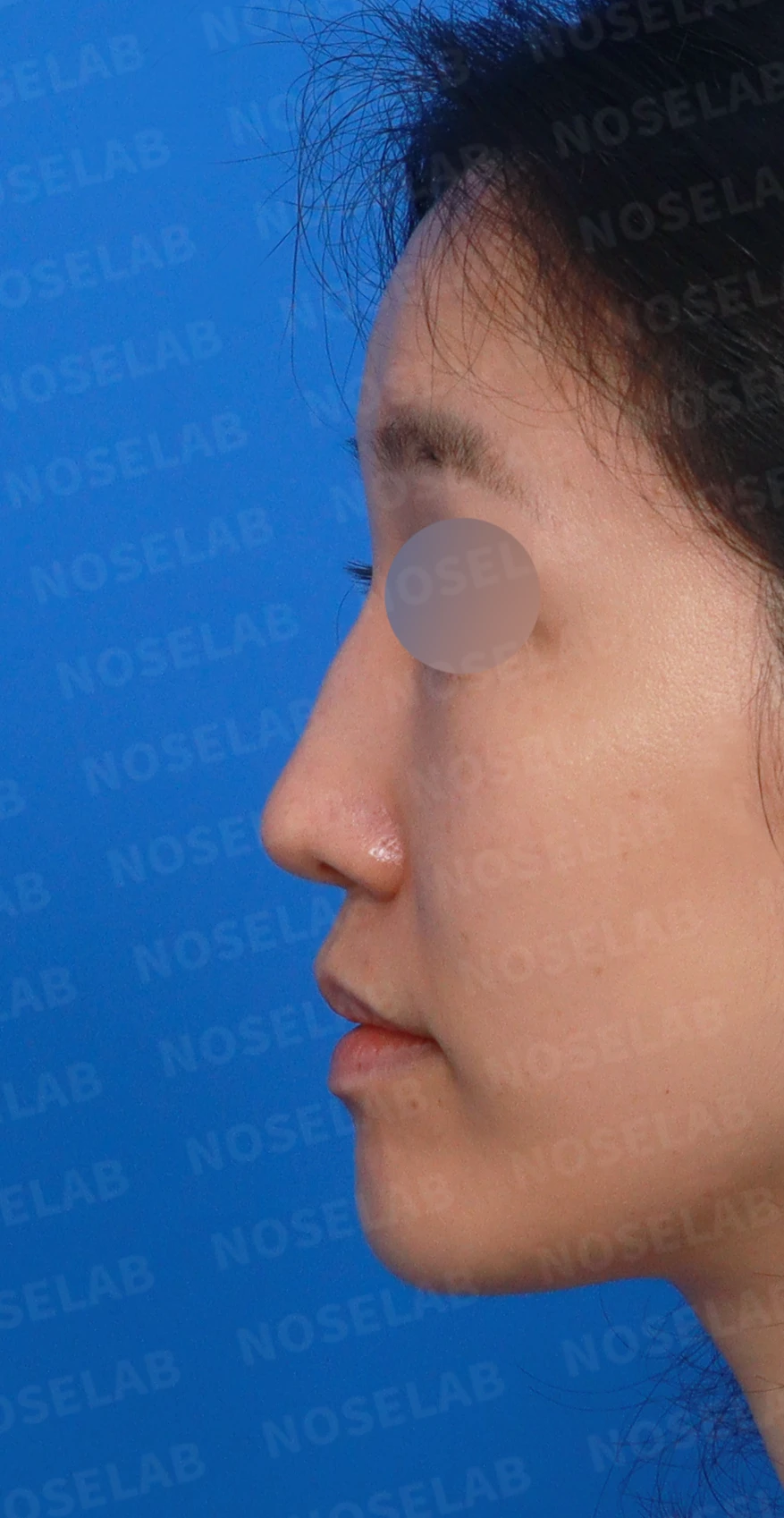 콧대 인공진피가 매부리로 남는 이유와 제거 후 재건 방법 — 디자인 상담 정면, 좌측 측면, 비스듬한 측면 사진입니다.