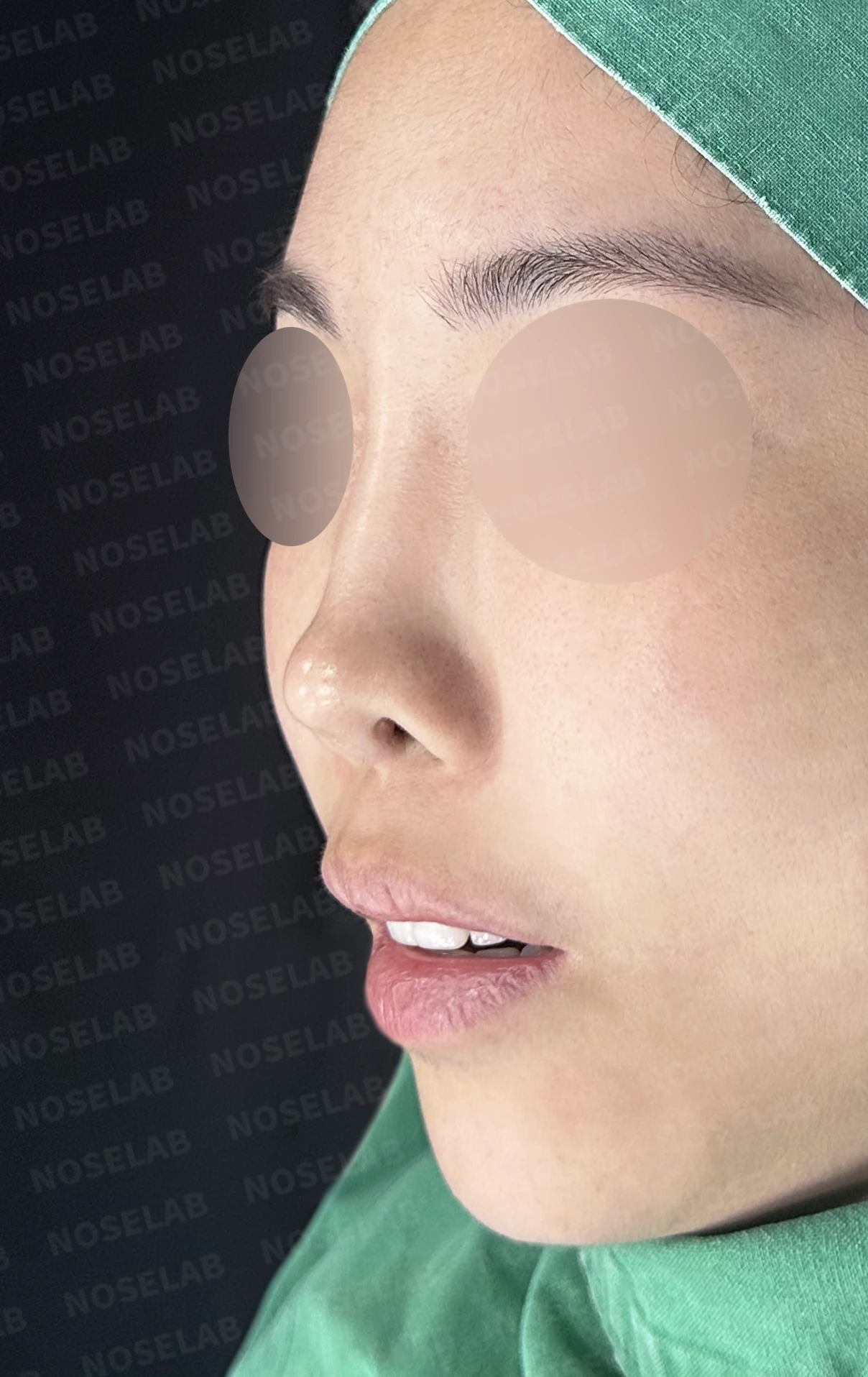 보형물을 넣고 빼기를 반복한 코에 남는 콧등 패임과 들린 느낌 — 수술 전 / 수술 직후 0일 직후 사진은 부기가 있는 상태로 최종 결과와 다를 수 있습니다.