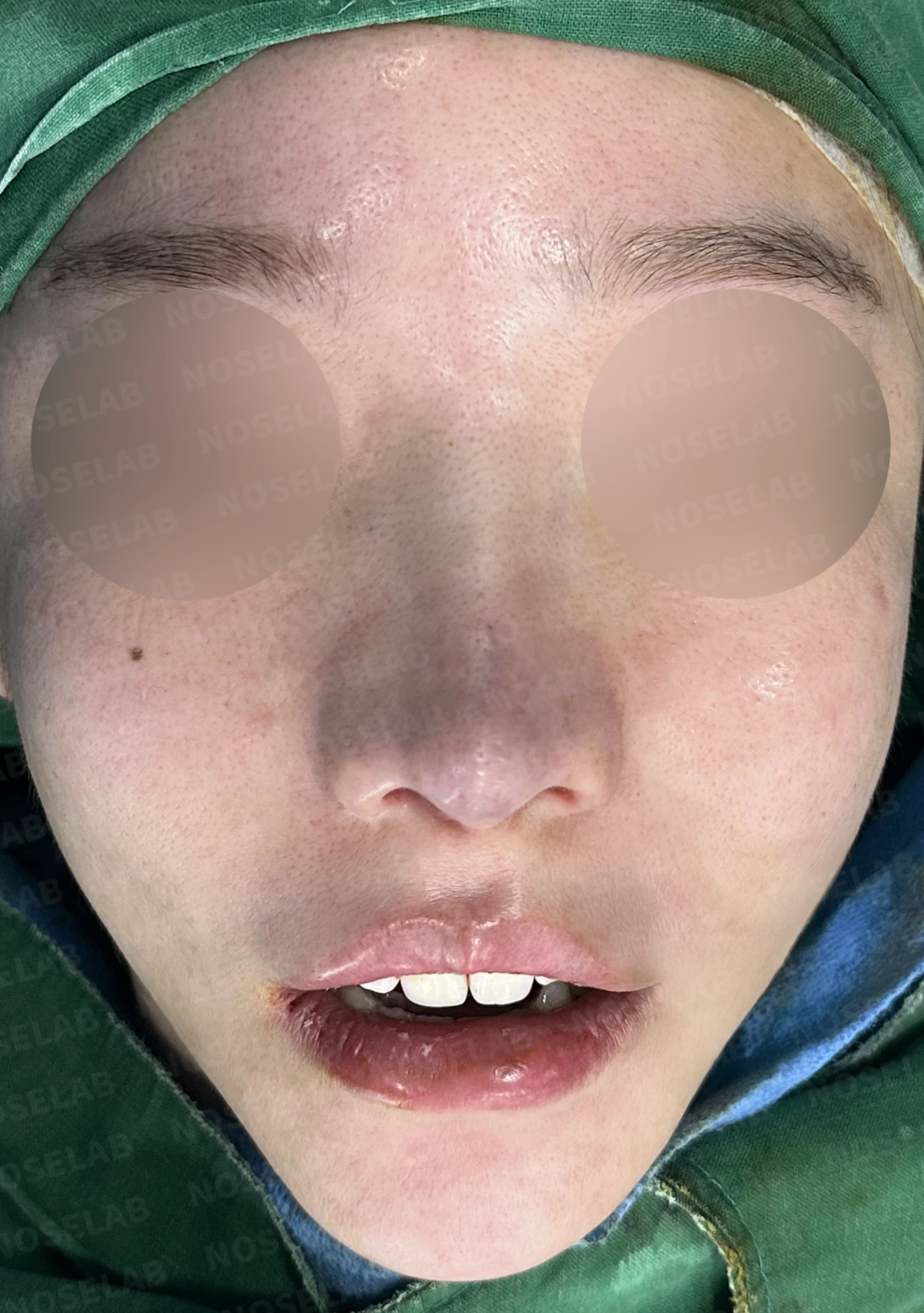 들린코와 비공 비대칭, 기증늑연골로 정교하게 교정한 코재수술 — 직후 정면, 비스듬한 측면, 측면 사진입니다.