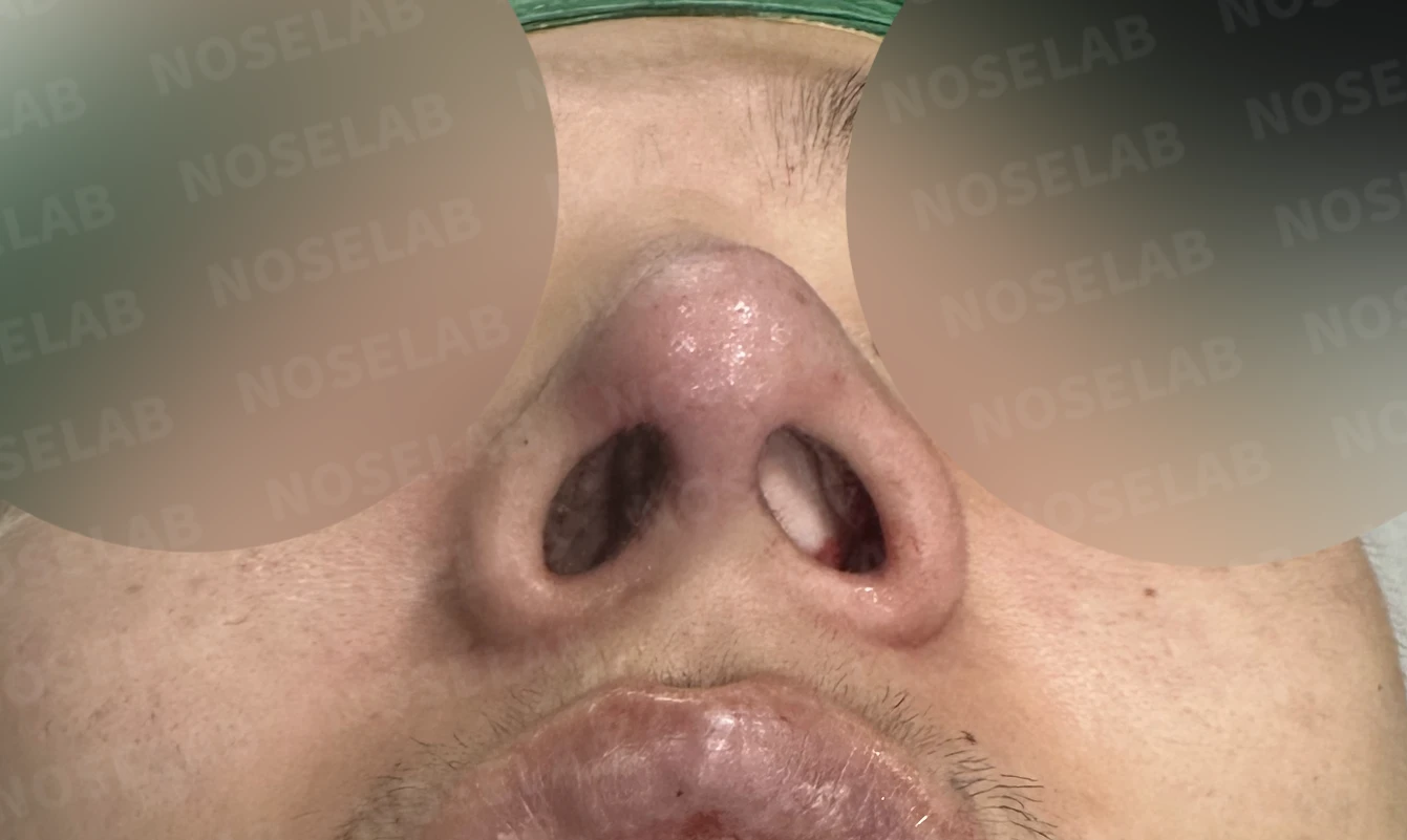 짧고 들린 코, 자가늑연골로 남성적인 라인으로 완성한 코재수술 — 전(좌) 직후(후)