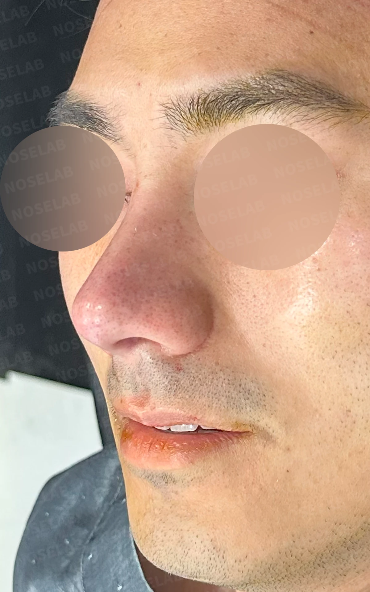 복코에 비공 비대칭과 코막힘이 함께 오는 이유, 직반 라인 교정은 어떻게 하나 — 수술 직후 0일 정면, 측면, 비스듬한 측면 사진 직후 사진은 부기가 있는 상태로 최종 결과와 다를 수 있습니다.