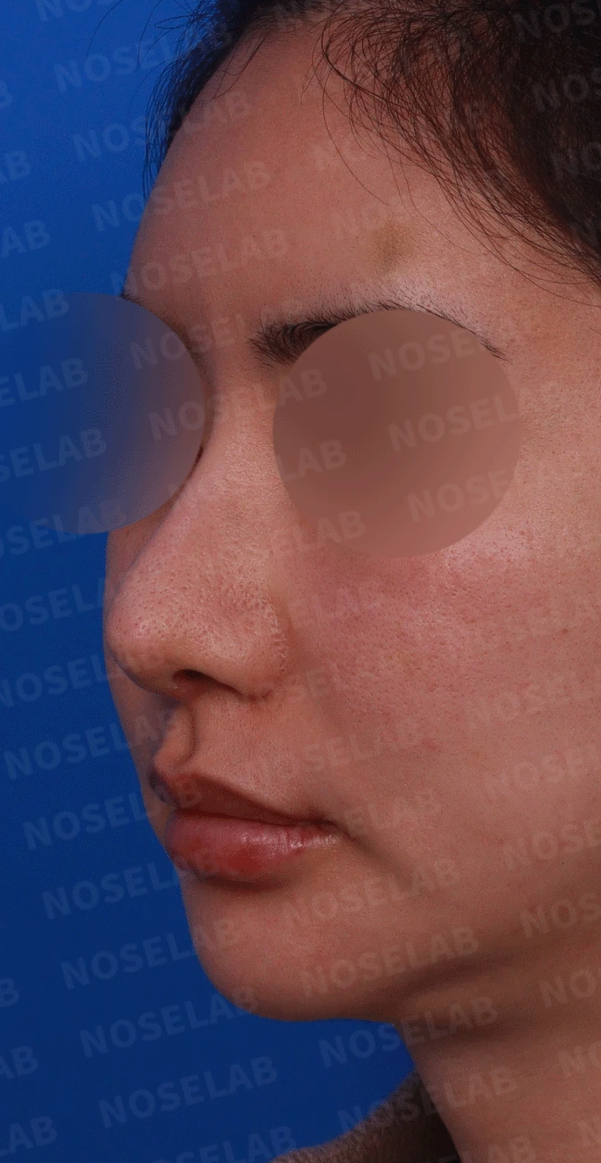코가 과하게 높아져 부자연스러워 보이고 휘는 이유, 재건은 어떻게 하나 — 디자인 상담 정면 , 좌측 비스듬한 측면 , 측면 사진입니다.