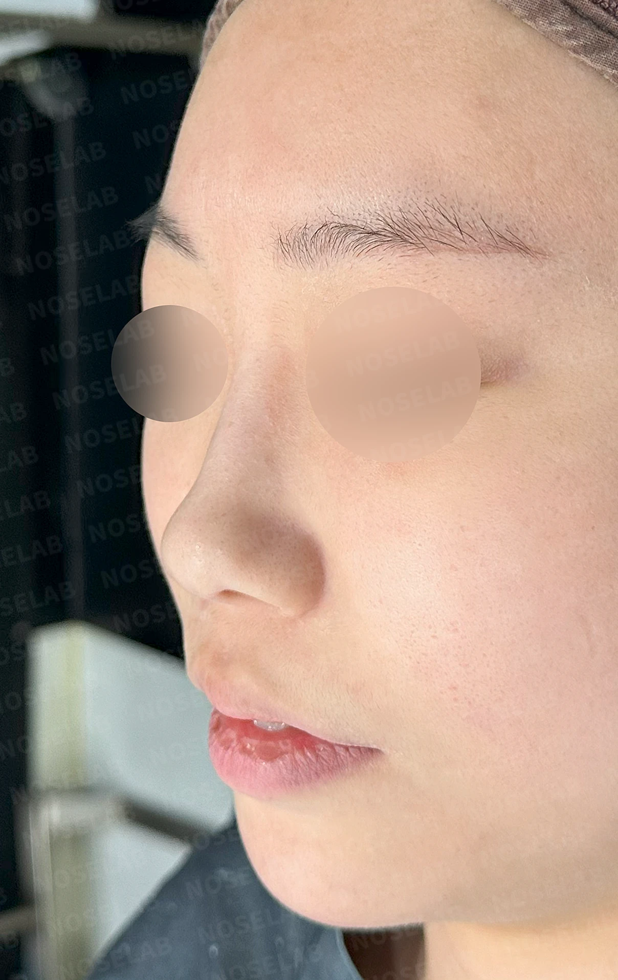 필러와 실이 남아 있는 코, 제거 후 늑연골 재건은 어디까지 가능한가 — 수술 전 / 수술 직후 0일 직후 사진은 부기가 있는 상태로 최종 결과와 다를 수 있습니다.