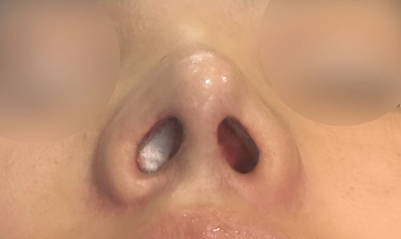 코성형 뒤 코끝이 처지고 웃을 때 퍼지는 이유, 이물질 제거와 코끝 교정 방법 — 수술 직후 0일 비공 사진입니다. 직후 사진은 부기가 있는 상태로 최종 결과와 다를 수 있습니다.