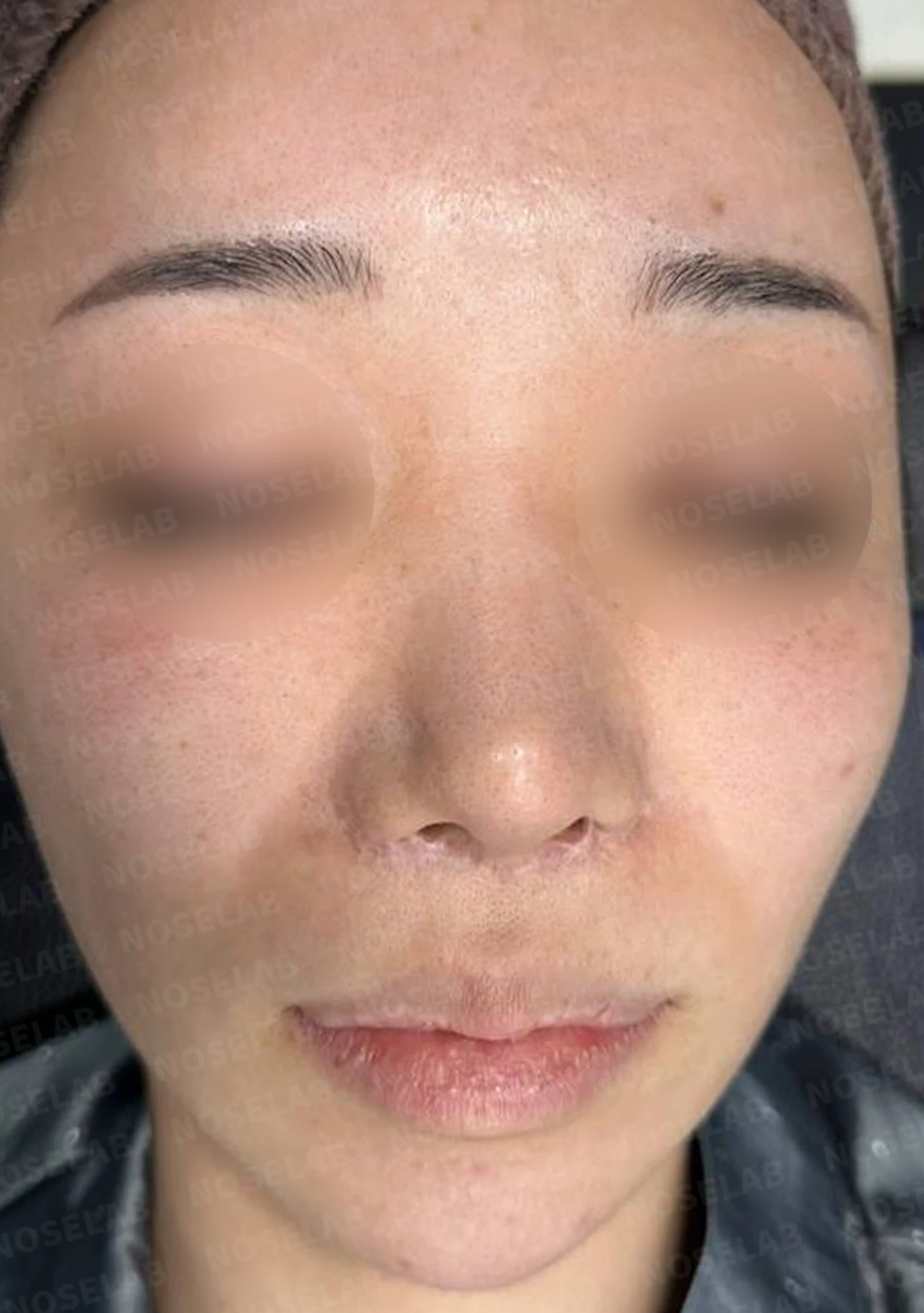 콧구멍 비대칭과 협착이 생기는 이유, 늑연골 재건과 Z성형은 어떻게 하나 — 수술 전 / 수술 직후 0일 직후 사진은 부기가 있는 상태로 최종 결과와 다를 수 있습니다.