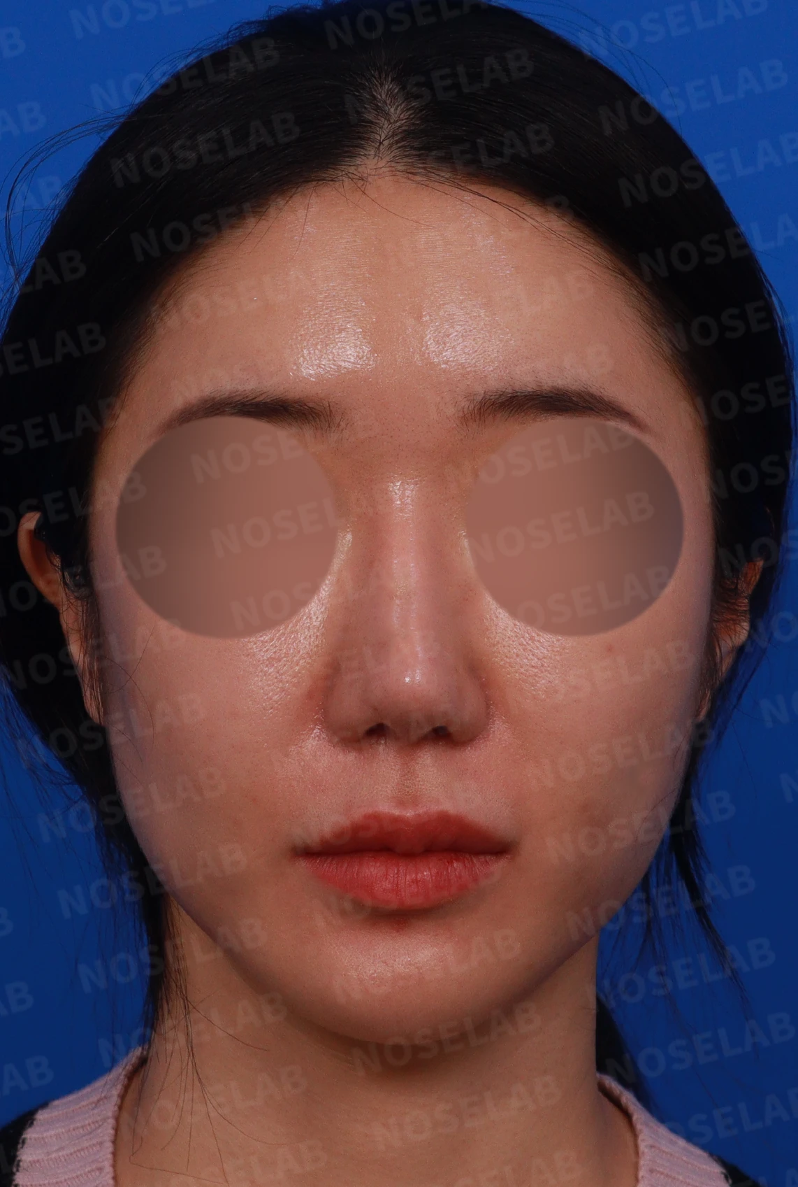 콧볼축소 후 남은 구조와 재건 방법 — 디자인 상담 정면, 좌측 측면, 비스듬한 측면 사진입니다.