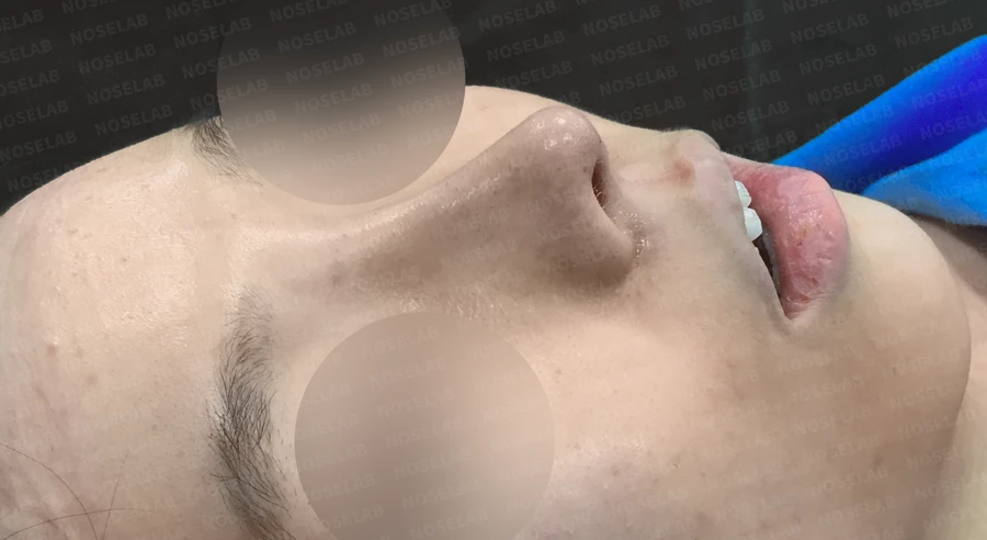 짧은 코의 비개방 교정 방법과 얼굴 비율 — 수술 전 / 수술 직후 0일 직후 사진은 부기가 있는 상태로 최종 결과와 다를 수 있습니다.