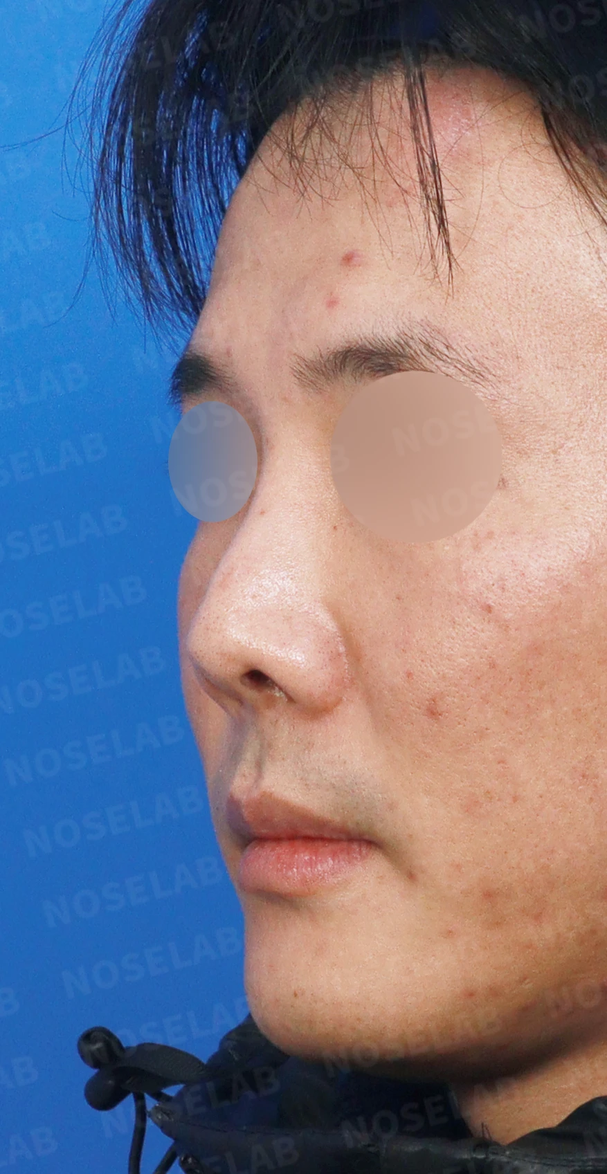 구축이 진행된 코, 조직 제거와 자가 늑연골 재건은 어떻게 하나 — 디자인 상담 정면, 좌측 측면, 비스듬한 측면 사진입니다.