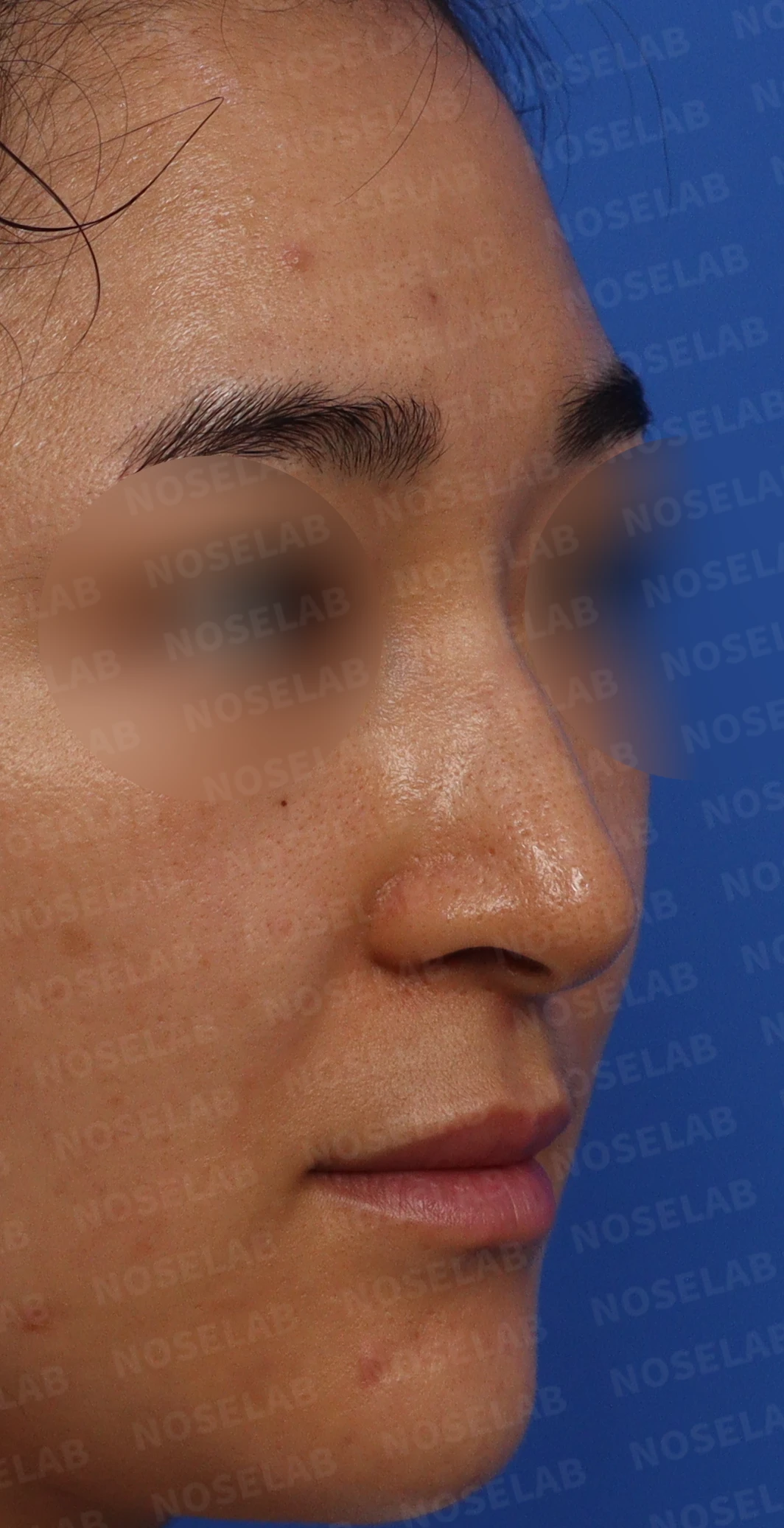매부리코, 코막힘 개선 코성형 방법 — 본문 사진 3
