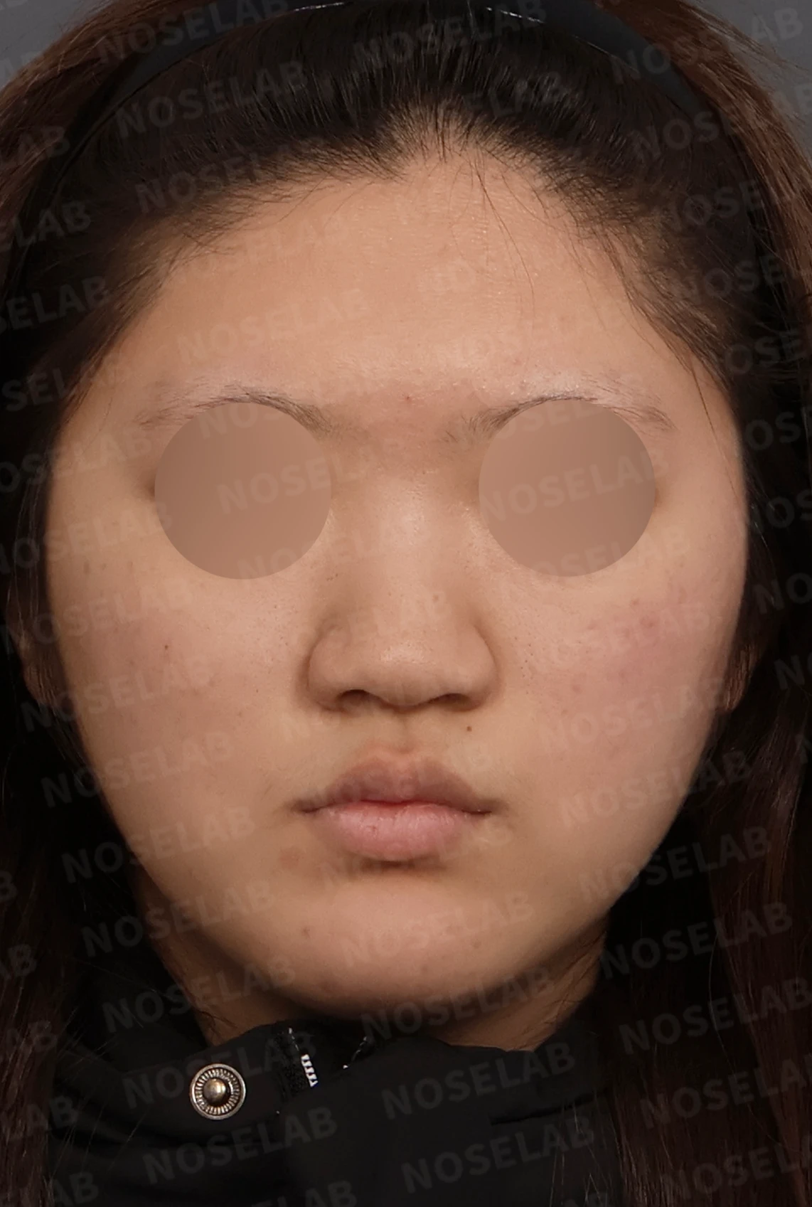 뭉툭한 코끝과 퍼진 코, 자가늑연골 비중격 연장술로 자연스럽게 교정 — 디자인 상담 정면, 좌측 측면, 비스듬한 측면 사진입니다.