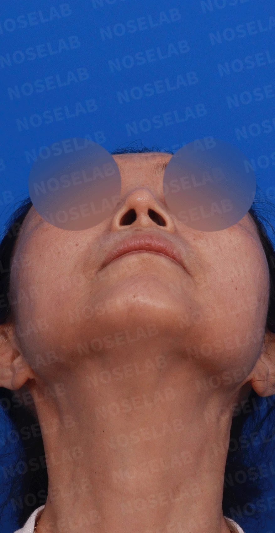 여러 차례 수술에도 코가 계속 휘는 이유, 비중격 연골 재건 방법 — 디자인 상담 우측 측면 , 비스듬한 측면 , 비공 사진입니다.