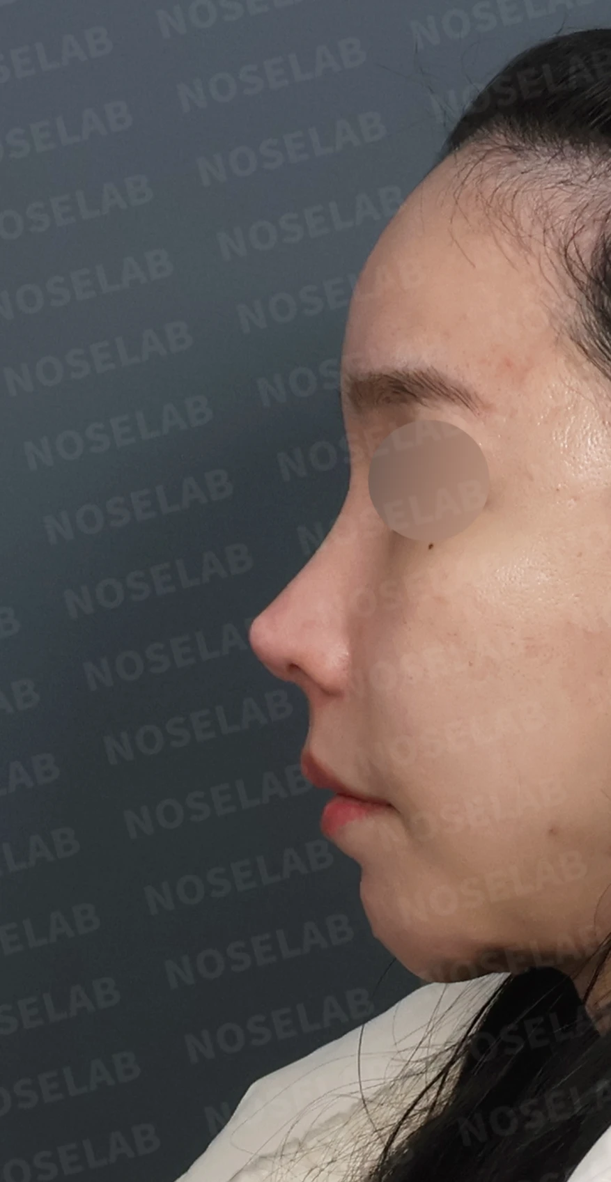 들린코와 비공 비대칭, 기증늑연골로 정교하게 교정한 코재수술 — 디자인 상담 정면, 좌측 측면, 비스듬한 측면 사진입니다.