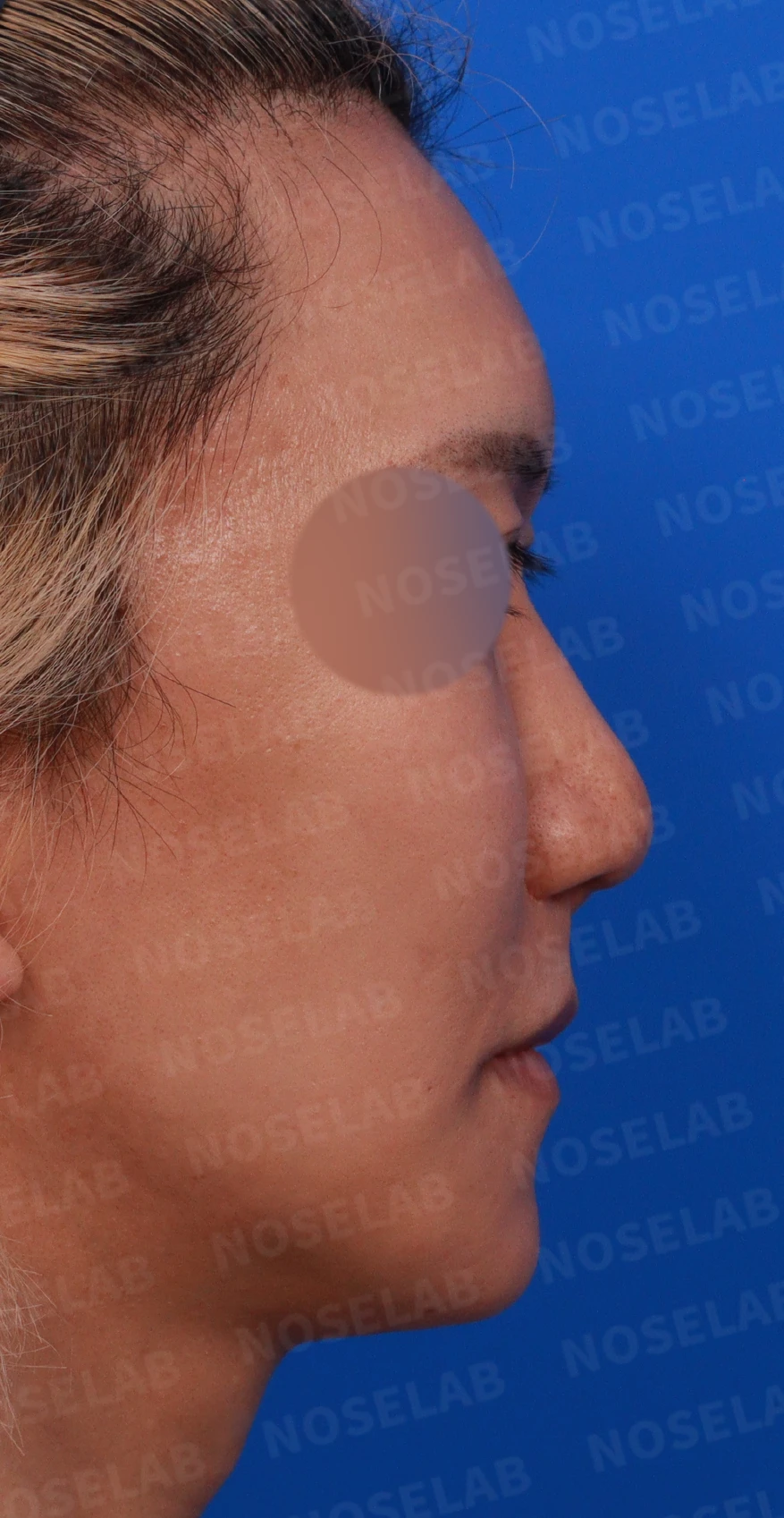 MRSA 감염 후 구축코의 구조와 재건 방법 — 수술전 디자인 상담 우측 비스듬한 측면, 우측 측면, 콧구멍사진