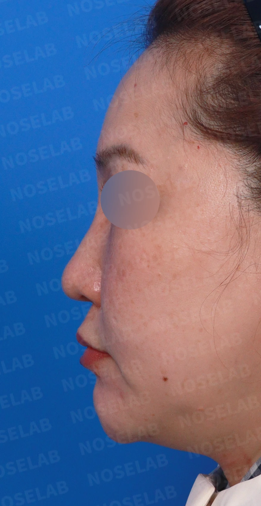 뭉툭하고 길게 처진 코가 중안면부를 길어 보이게 하는 이유, 석회화된 늑연골 재건 방법 — 디자인 상담 정면, 좌측 측면, 비스듬한 측면 사진입니다.