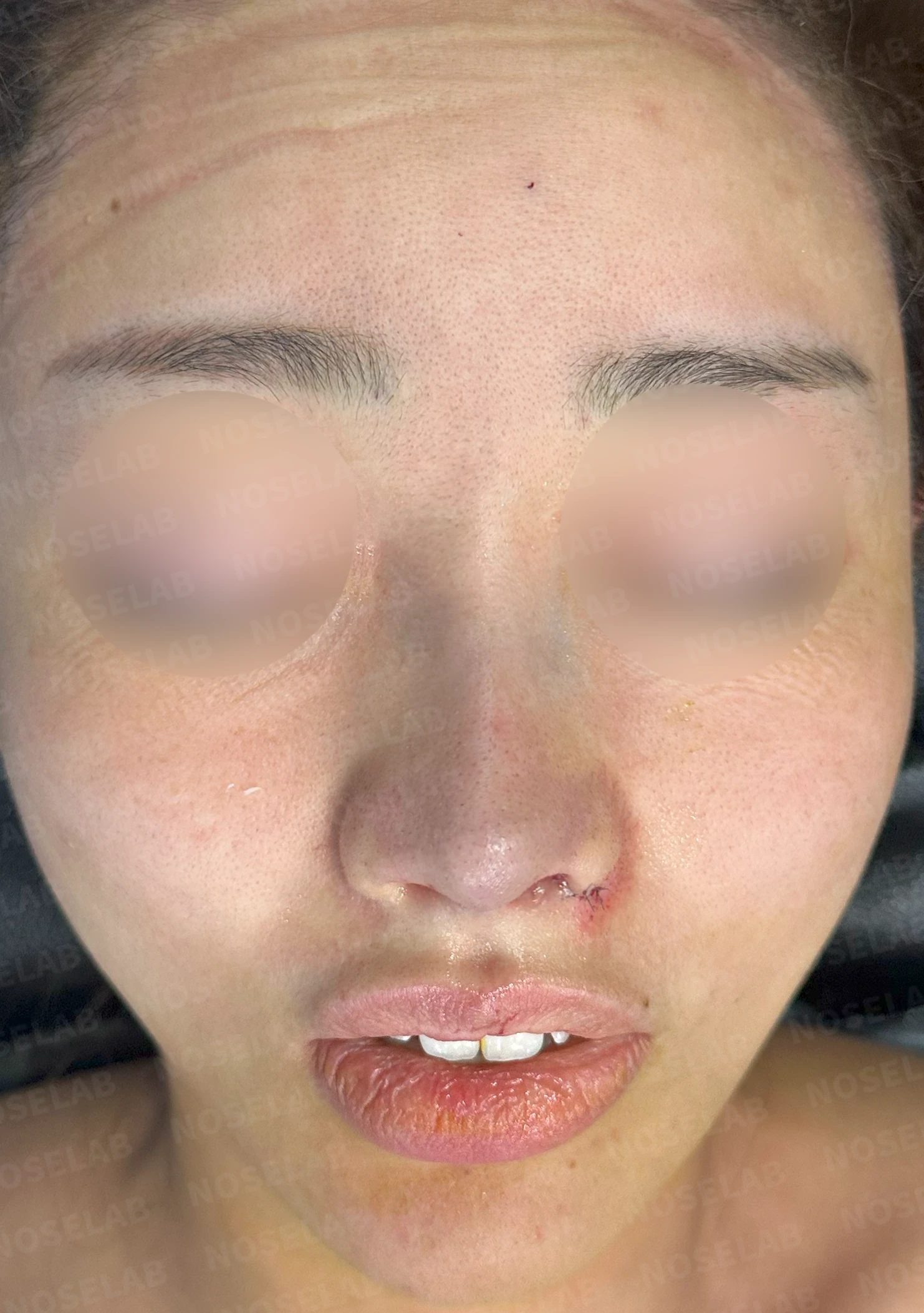 비공협착과 휜코, 코막힘을 함께 살펴보는 재수술 방법 — 수술 직후 0일 정면, 측면, 비스듬한 측면 직후 사진은 부기가 있는 상태로 최종 결과와 다를 수 있습니다.