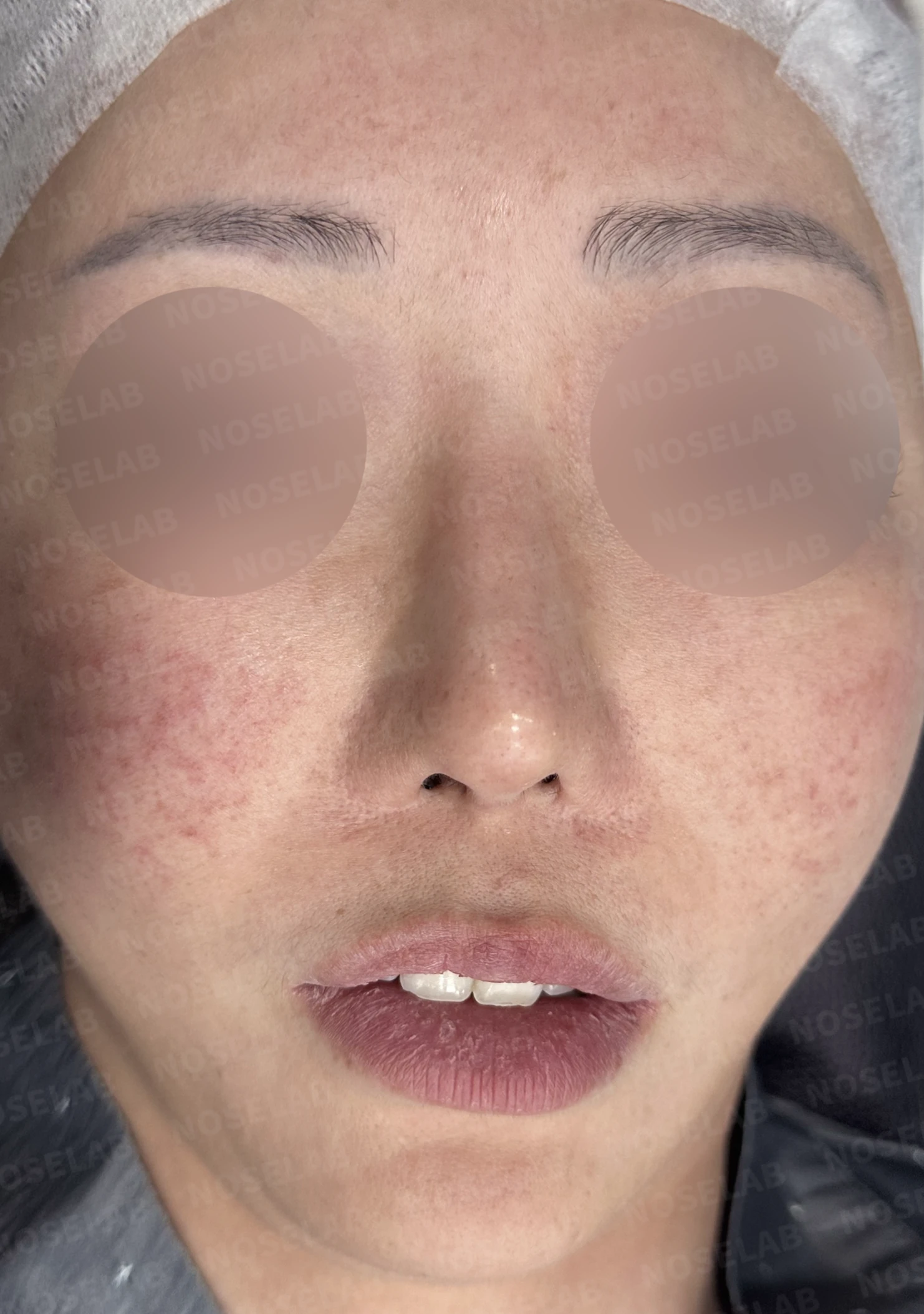 코성형 뒤 코막힘이 더 심해지는 이유, 비중격 재건과 절골 복원은 어떻게 하나 — 수술 전 / 수술 직후 0일 직후 사진은 부기가 있는 상태로 최종 결과와 다를 수 있습니다.