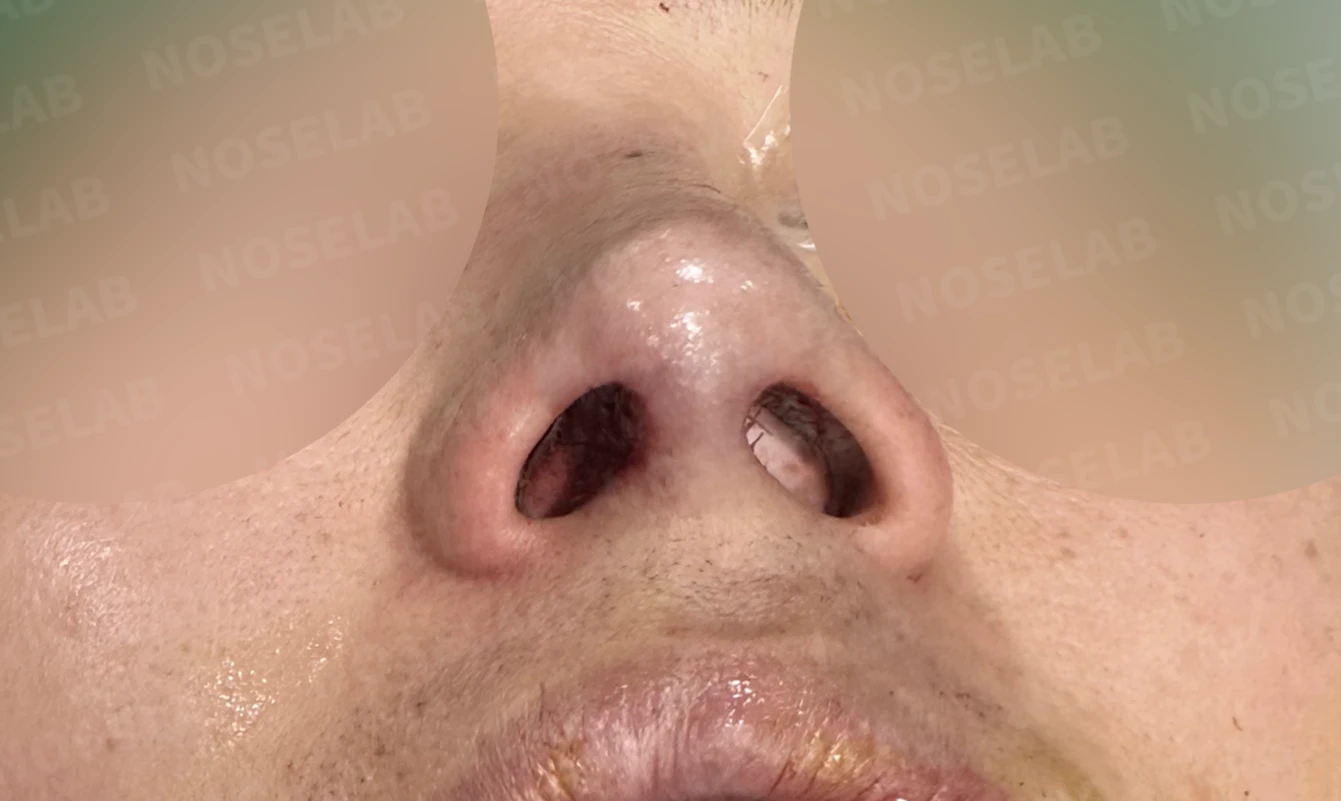 코막힘과 휘어진 비중격, 자가늑연골로 기능과 모양을 동시에 개선 — 직후 비공 사진입니다.