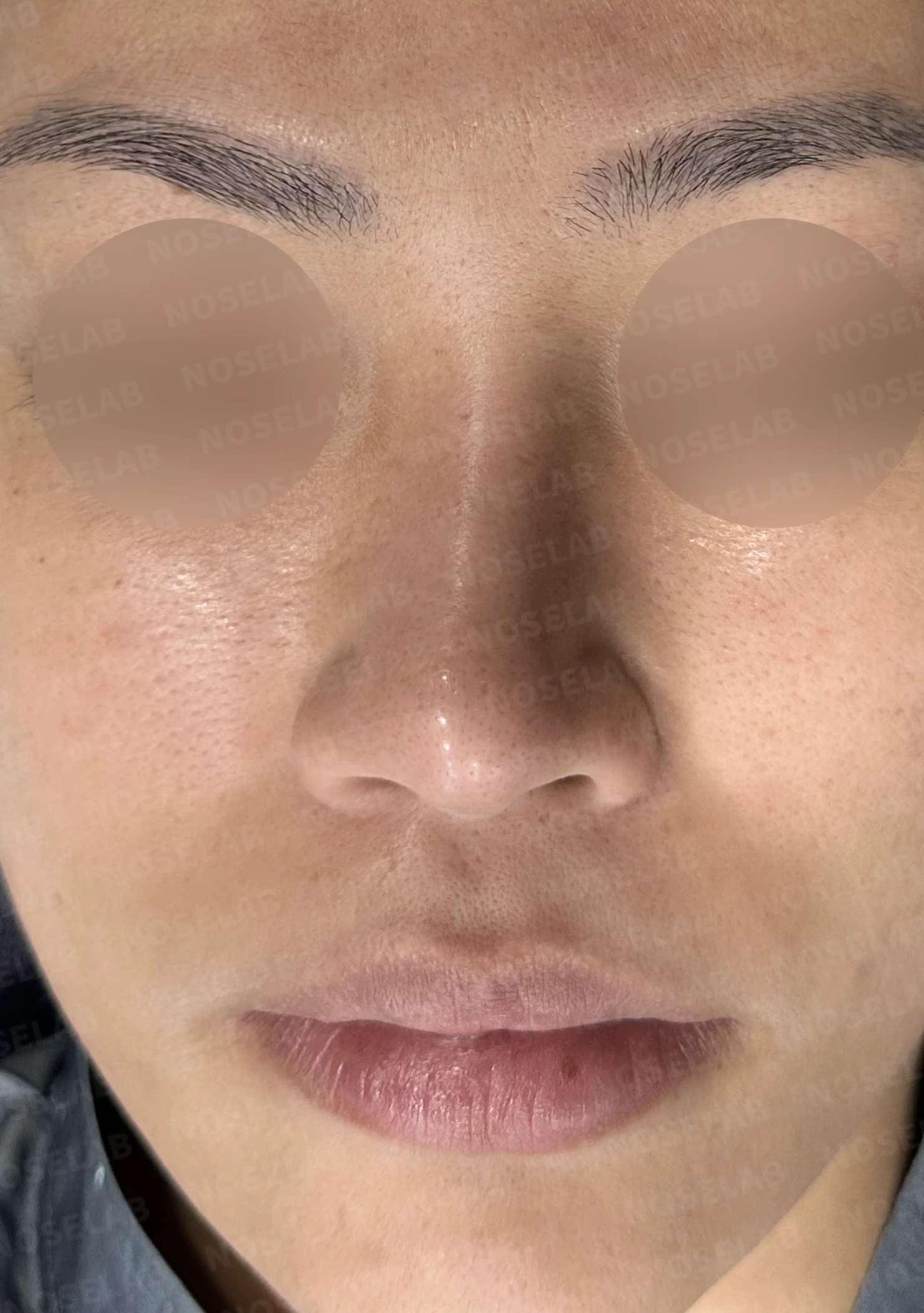 오래된 보형물 코의 코끝 지지력이 약해지는 이유와 비중격연장 재건 방법 — 수술 전 / 수술 직후 0일 직후 사진은 부기가 있는 상태로 최종 결과와 다를 수 있습니다.
