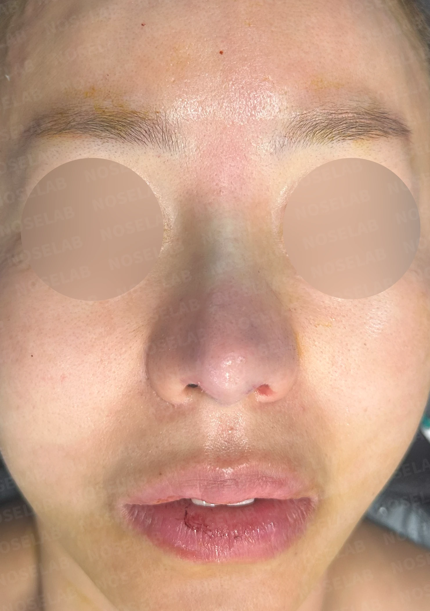 보형물을 제거한 뒤 콧대가 꺼지고 퍼지는 이유, 재건은 어떻게 하나 — 수술 직후 0일 정면, 비스듬한 측면, 측면 사진입니다. 직후 사진은 부기가 있는 상태로 최종 결과와 다를 수 있습니다.