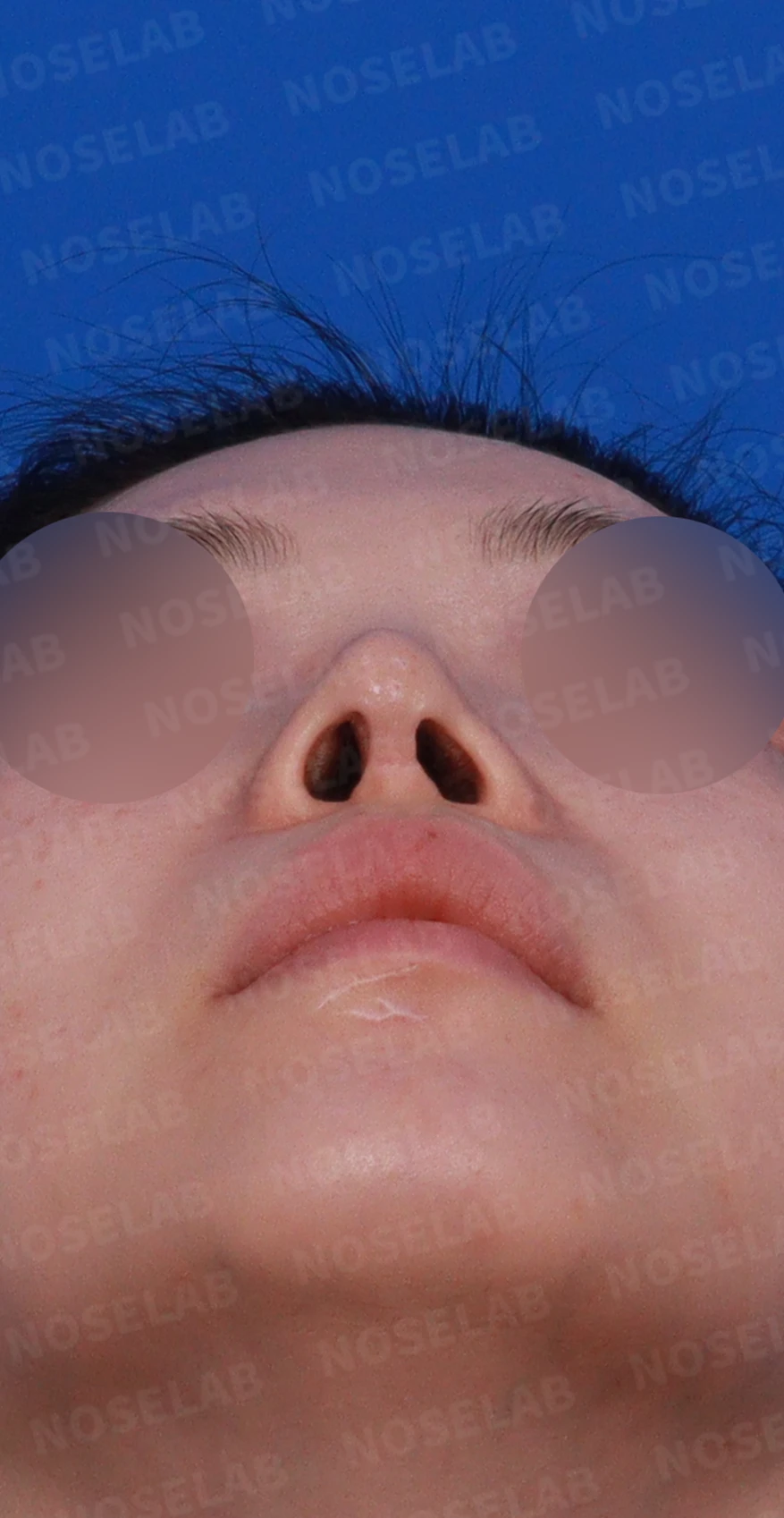 비중격 연골을 과도하게 채취하면 생기는 문제와 재건 방법 — 디자인 상담 비스듬한 측면, 우측 측면, 비공 사진 사진입니다.