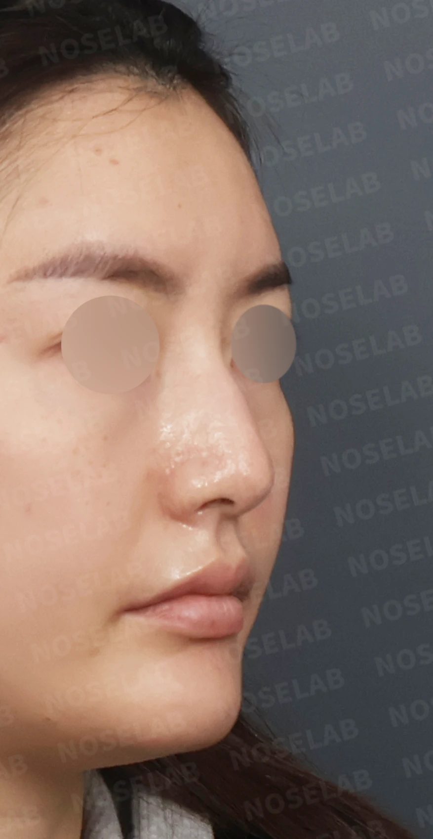 매부리코 교정, 자가늑연골로 자연스러운 코 라인 완성 — 디자인 상담 우측 측면, 비스듬한 측면, 비공 사진입니다.
