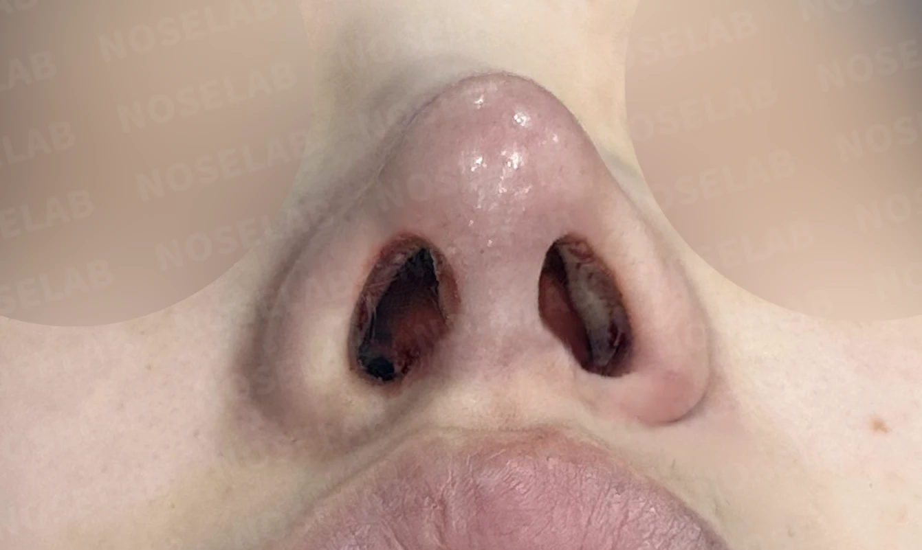 비중격이 심하게 휘고 손상되는 이유, 늑연골 재건은 어떻게 하나 — 수술 전 / 수술 직후 0일 직후 사진은 부기가 있는 상태로 최종 결과와 다를 수 있습니다.
