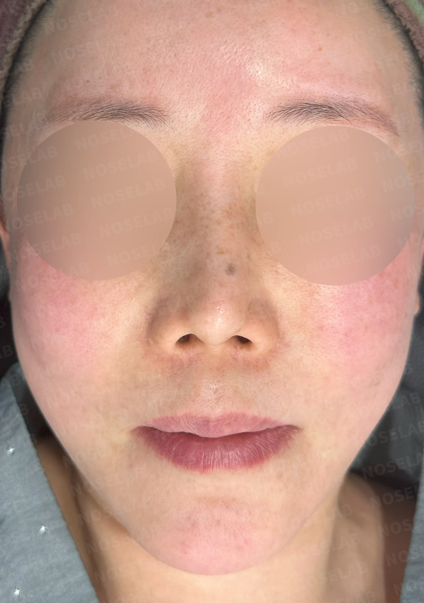 귀족수술 보형물이 코 안으로 밀려 나와 숨이 막히는 이유와 재건 방법 — 본문 사진 8
