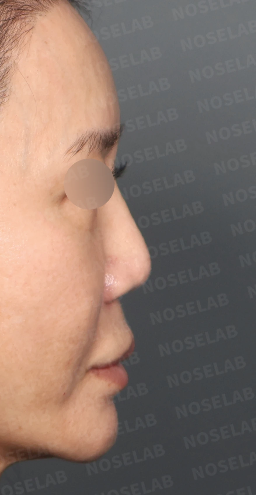 실리콘 재수술, 자가늑연골로 안전하게 코 라인 교정한 사례 — 디자인 상담 우측 측면, 비스듬한 측면, 비공 사진입니다.