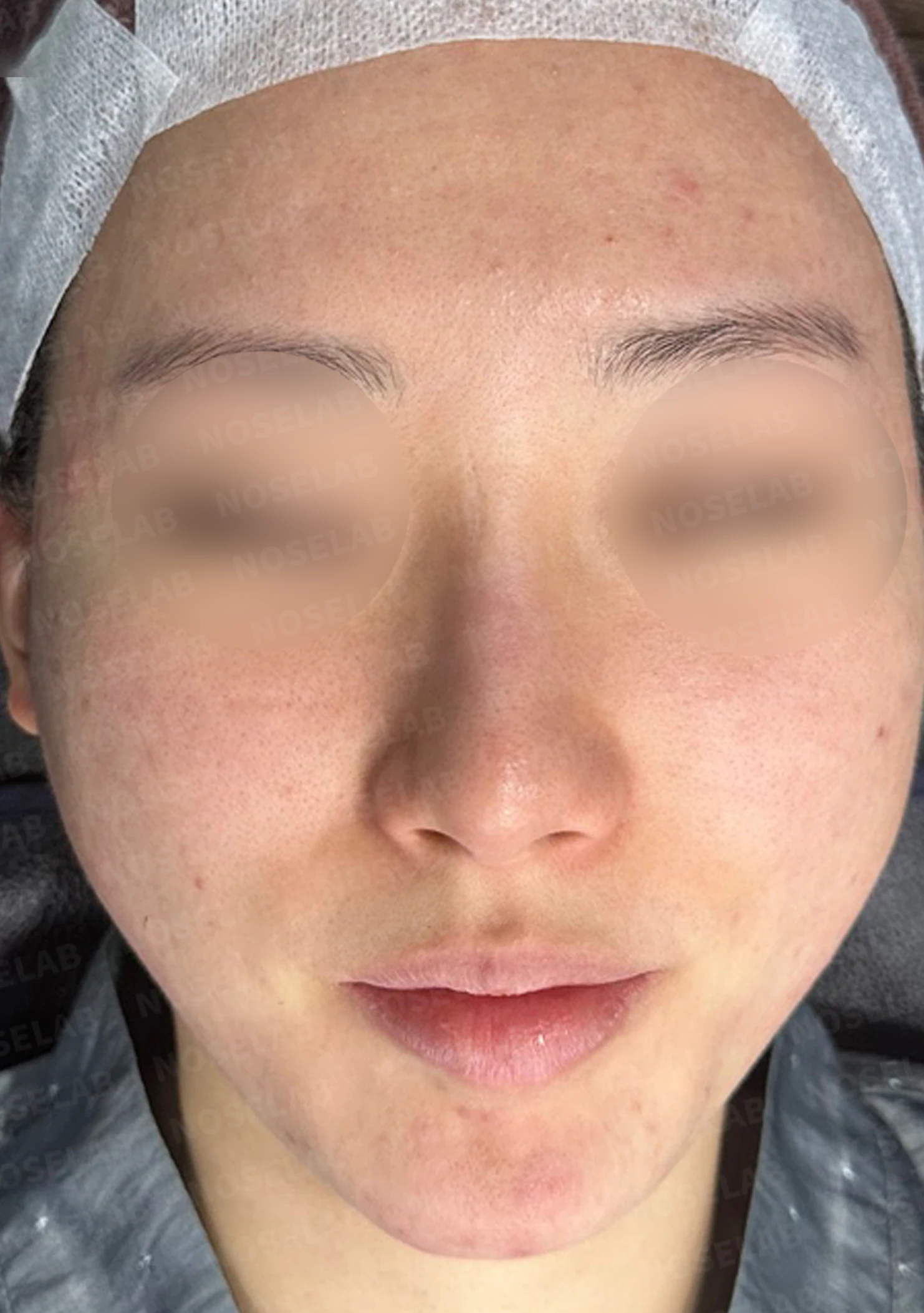 코 필러 뒤에도 휜 코와 코막힘이 남는 이유, 교정은 어떻게 하나 — 수술 전 / 수술 직후 0일 직후 사진은 부기가 있는 상태로 최종 결과와 다를 수 있습니다.
