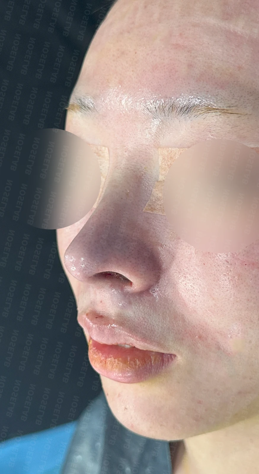 퍼진코, 복코 교정으로 균형 잡힌 이미지 완성 — 직후 정면, 비스듬한 측면, 측면
