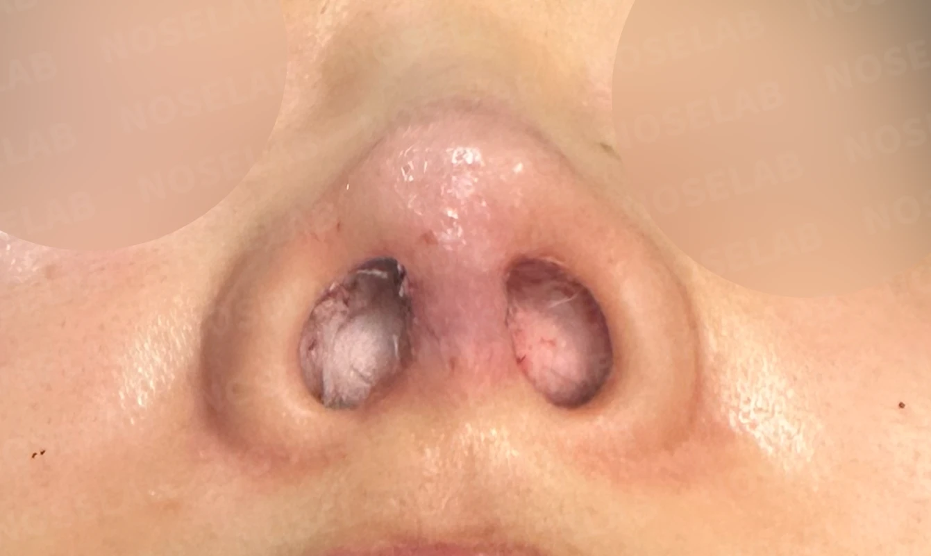 코가 들리고 콧기둥이 꺼지며 코끝이 찝혀 보이는 이유, 복합 교정은 어떻게 하나 — 본문 사진 22