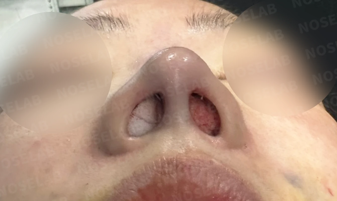 재수술한 코가 휘어 보이고 코끝이 처지는 이유 — 수술 직후 0일 비공 사진입니다. 직후 사진은 부기가 있는 상태로 최종 결과와 다를 수 있습니다.