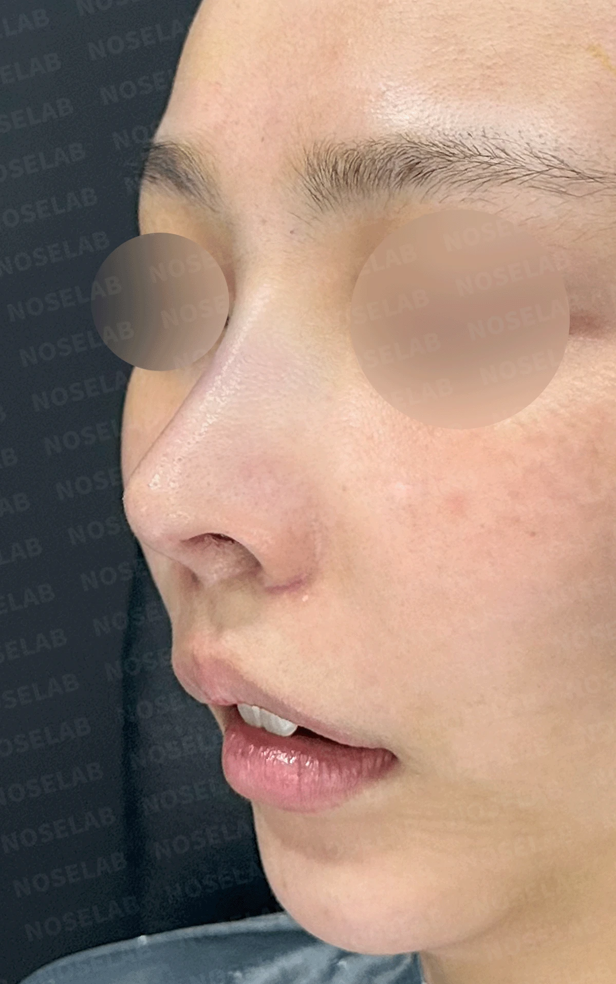 여러 번 수술해도 콧대가 낮고 복코가 남는 이유, 늑연골 재건과 얼굴 균형 — 본문 사진 12