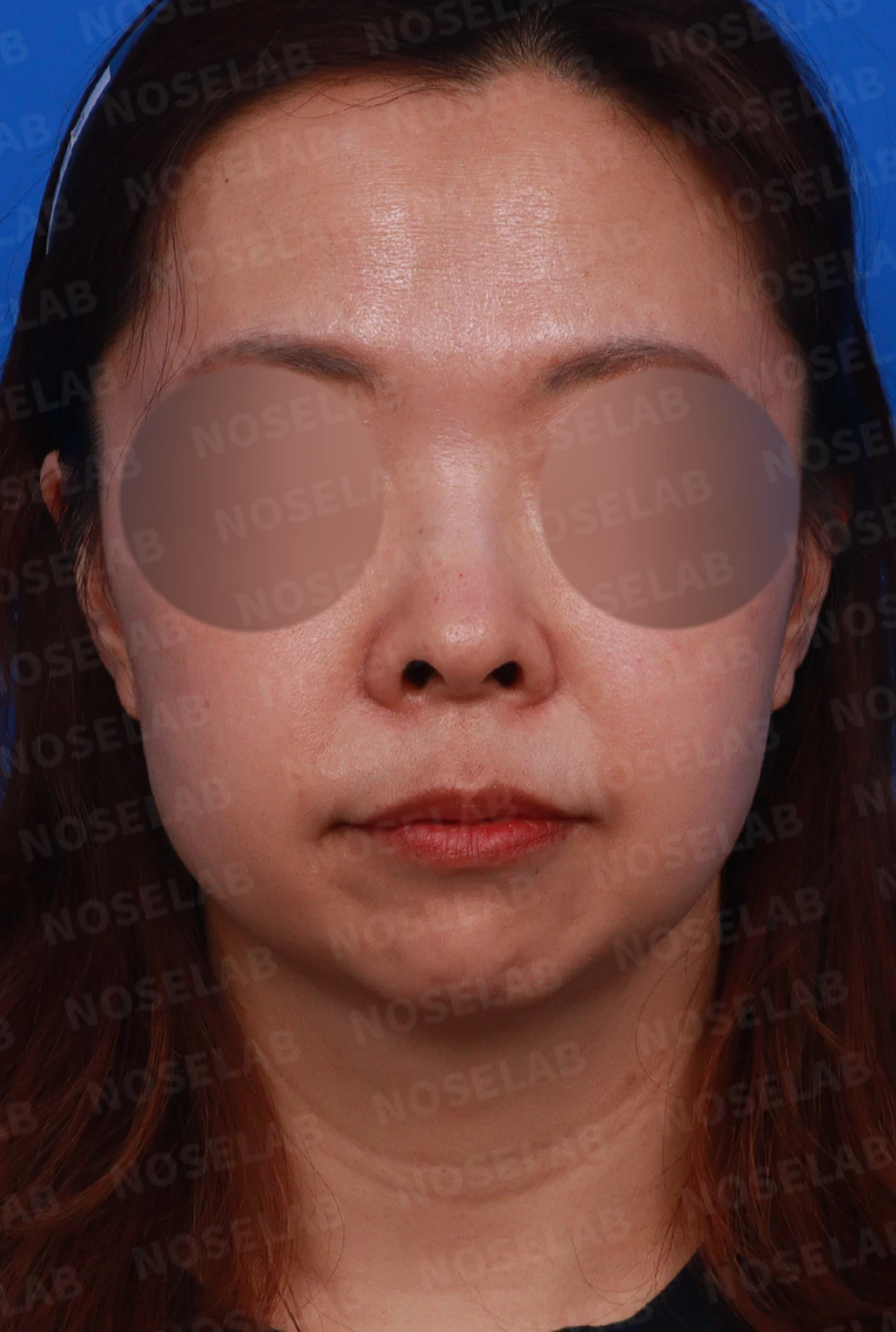 들창코에서 콧구멍이 많이 보이는 이유, 코끝 위치 교정은 어떻게 하나 — 디자인 상담 정면, 좌측 측면, 비스듬한 측면 사진