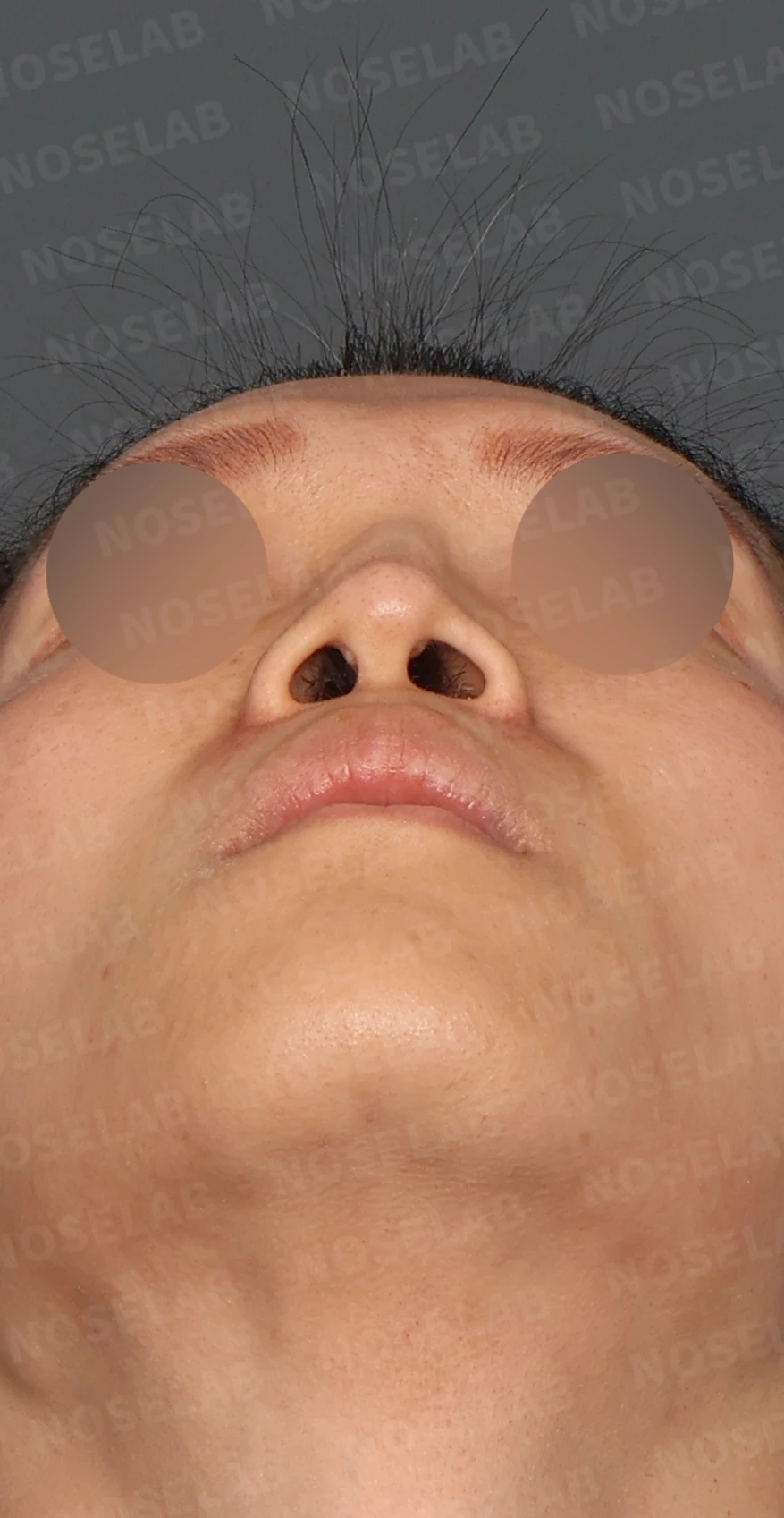2차 코재수술, 자가늑연골로 비중격 재건과 직선 코 라인 완성 — 디자인 상담 우측 측면, 비스듬한 측면, 비공 사진
