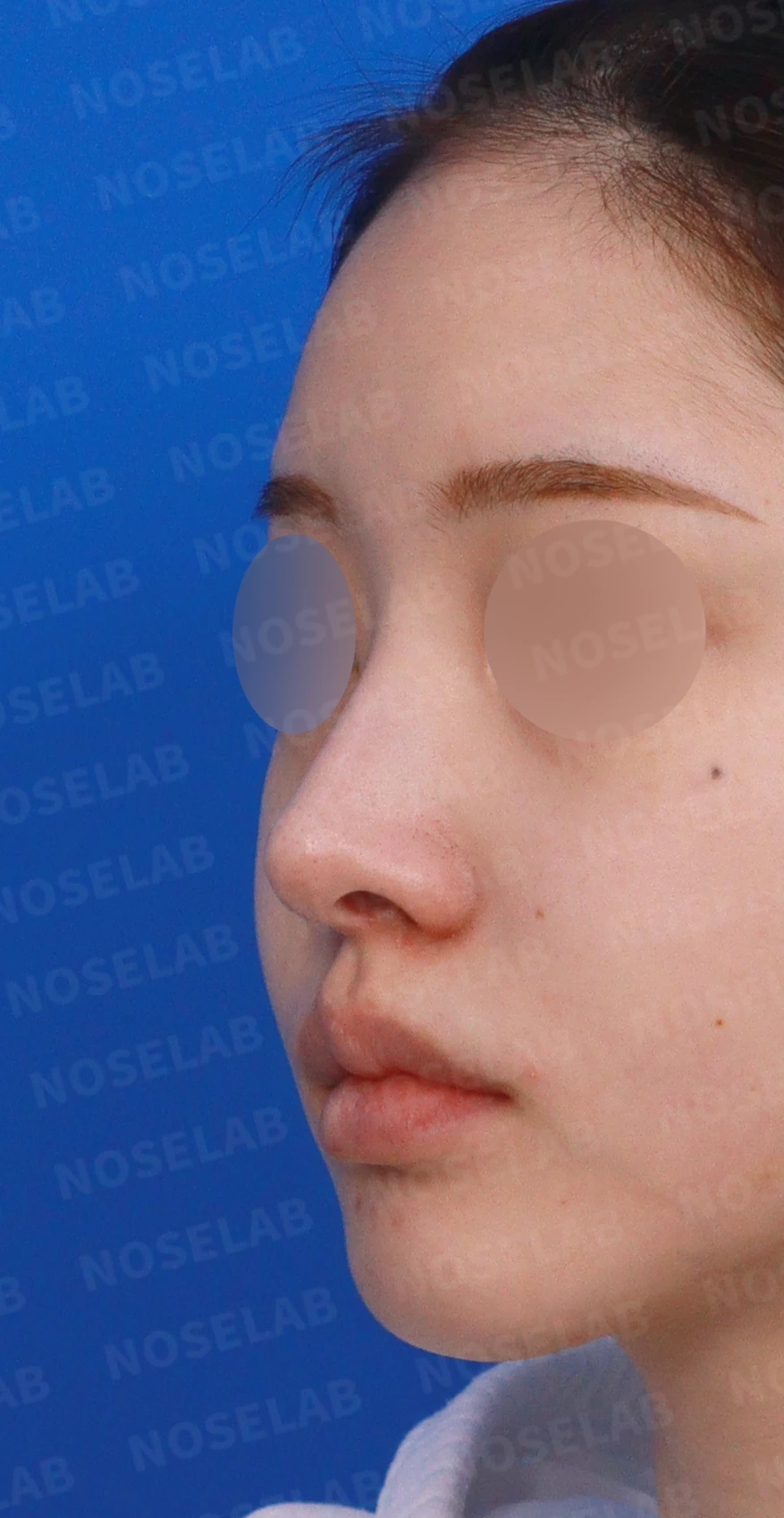 비중격이 심하게 휘고 손상되는 이유, 늑연골 재건은 어떻게 하나 — 디자인 상담 정면, 좌측 측면, 비스듬한 측면 사진입니다.