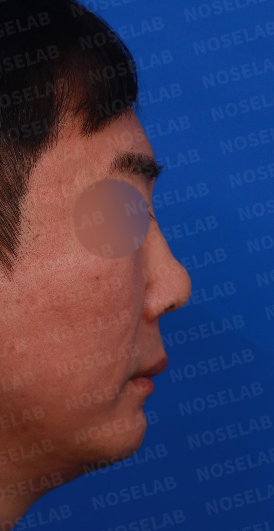 매부리코 수술 후 비대칭의 재수술 방법 — 디자인 상담 우측 비스듬한 측면, 측면, 비공 사진입니다.