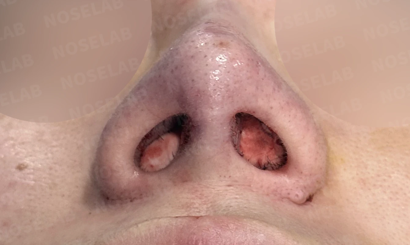 콧대를 더 높이고 싶을 때 무엇이 한계를 만드나, 3D 맞춤 보형물과 자가늑연골 코끝 지지 — 수술 전 / 수술 직후 0일 직후 사진은 부기가 있는 상태로 최종 결과와 다를 수 있습니다.