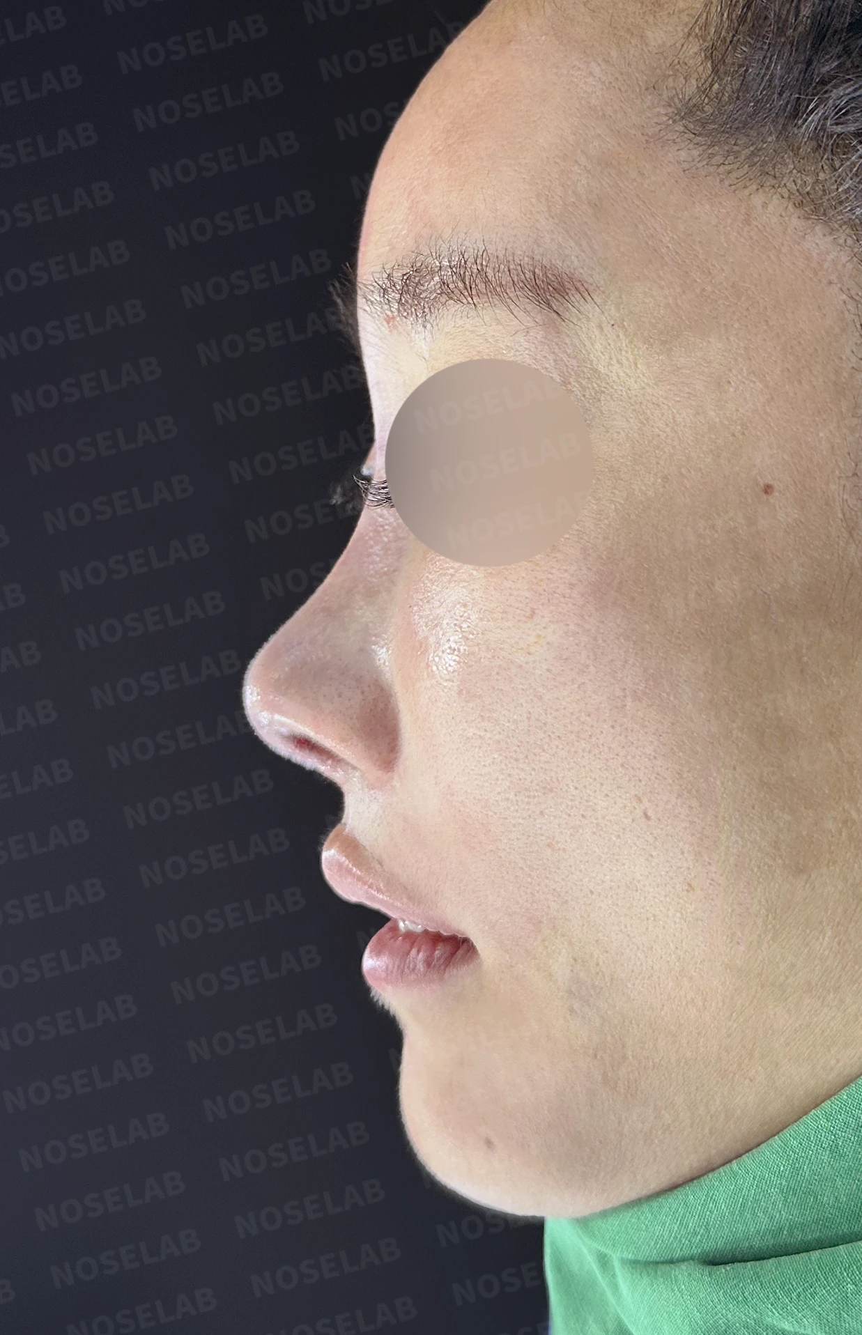 콧대에 주입한 불법 시술 이물질, 제거와 비중격 전체 재건은 어떻게 하나 — 수술 직후 0일 정면, 비스듬한 측면, 측면 사진입니다. 직후 사진은 부기가 있는 상태로 최종 결과와 다를 수 있습니다.