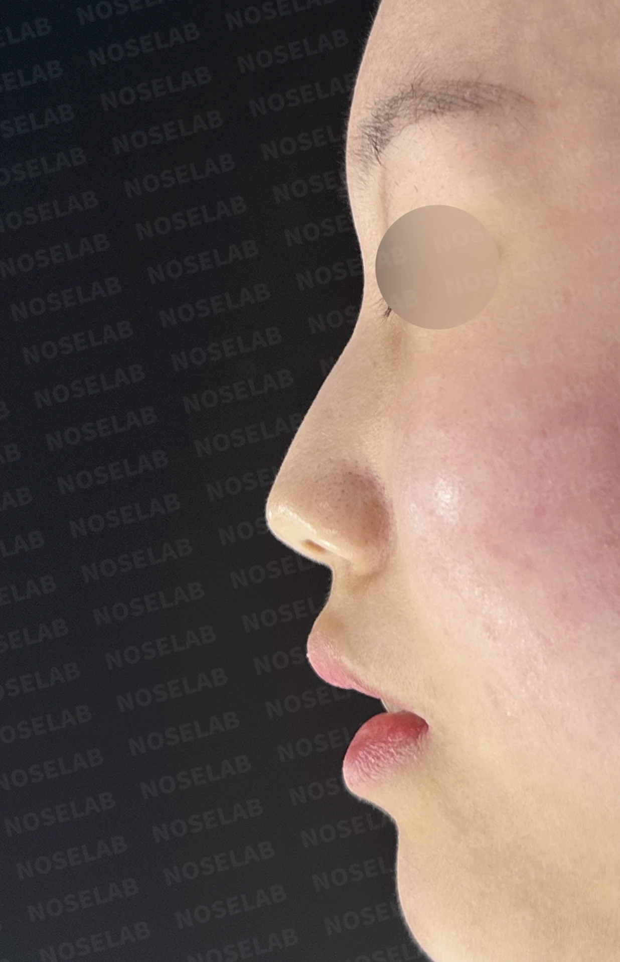무보형물 코성형, 휘어진 콧대와 처진 코끝을 자연스럽게 교정 — 전(좌) 직후(후)