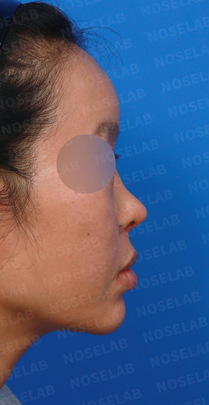 이식한 진피가 흡수되어 콧대가 퍼지고 코가 들려 보이는 이유와 교정 방법 — 디자인 상담 우측 측면, 비스듬한 측면, 비공 사진입니다.