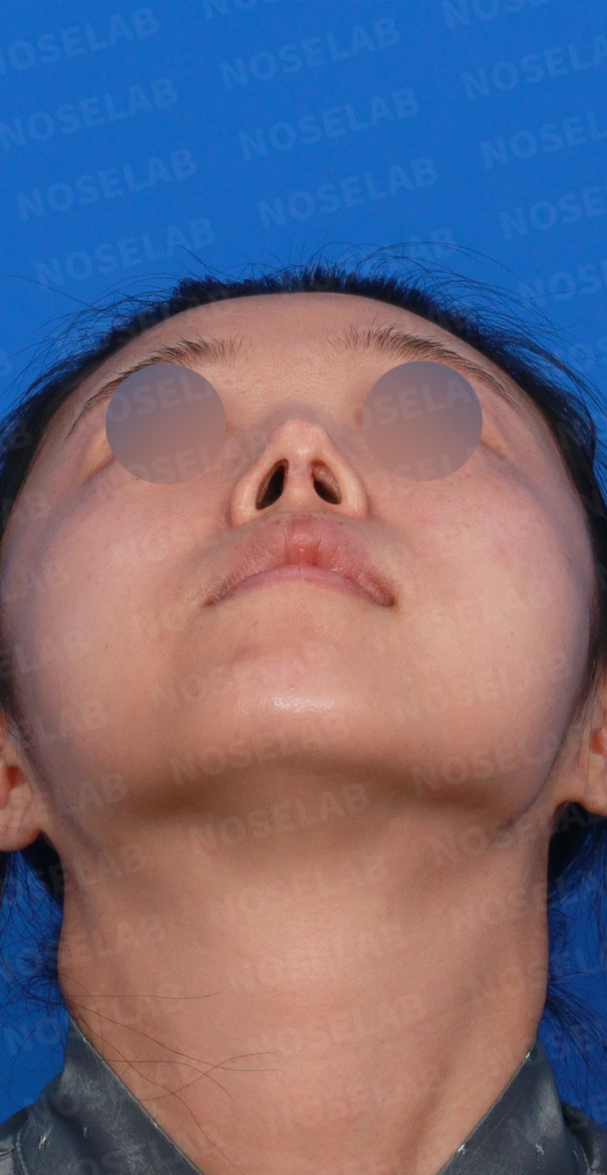 코끝 피부가 얇아져 연골이 비치는 이유, 피부 보강은 어떻게 하나 — 디자인 상담 우측 측면, 비스듬한 측면, 비공 사진입니다.