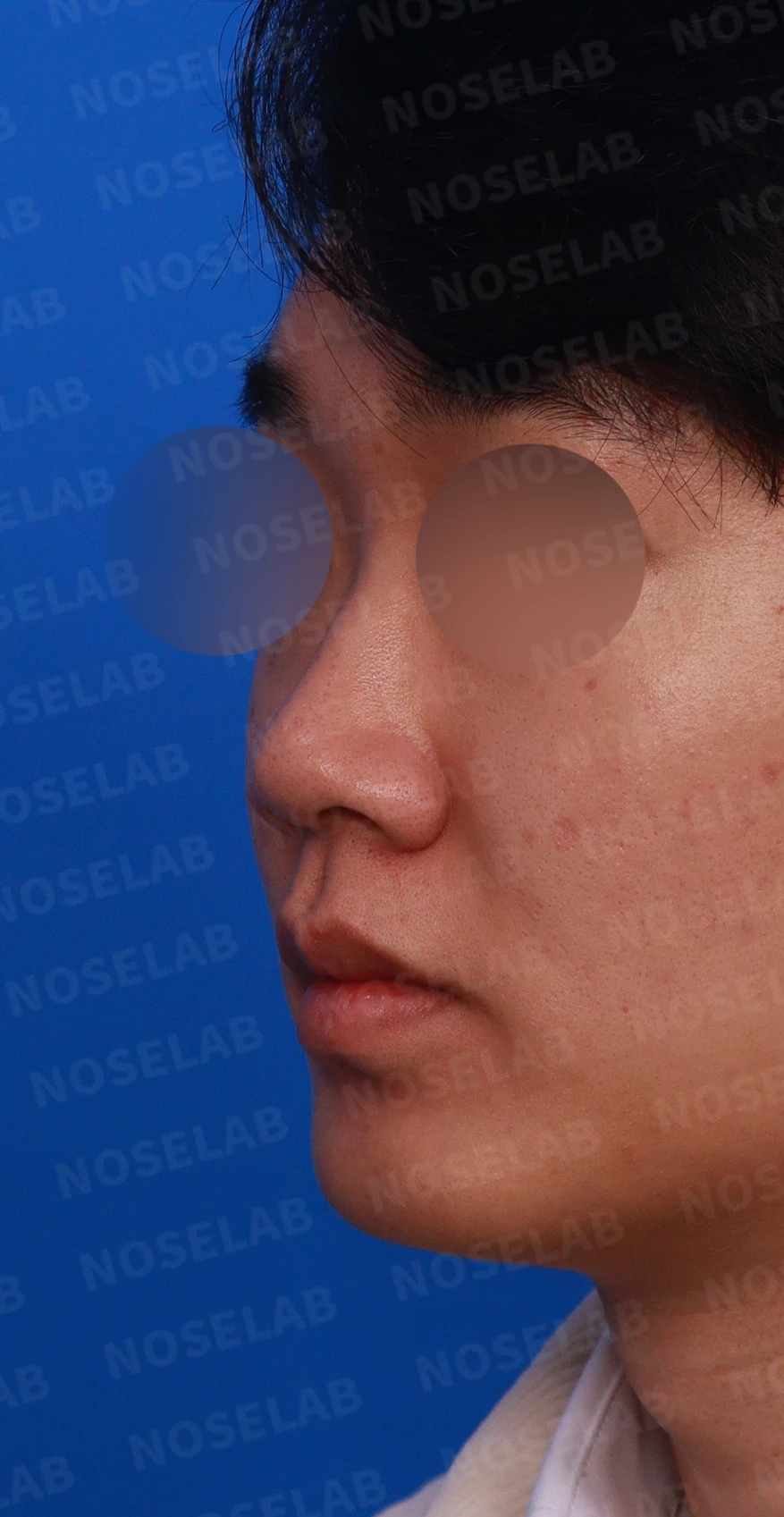 낮은 코와 코막힘을 함께 살펴보는 교정 방법 — 디자인 상담 정면, 좌측 측면, 비스듬한 측면 사진