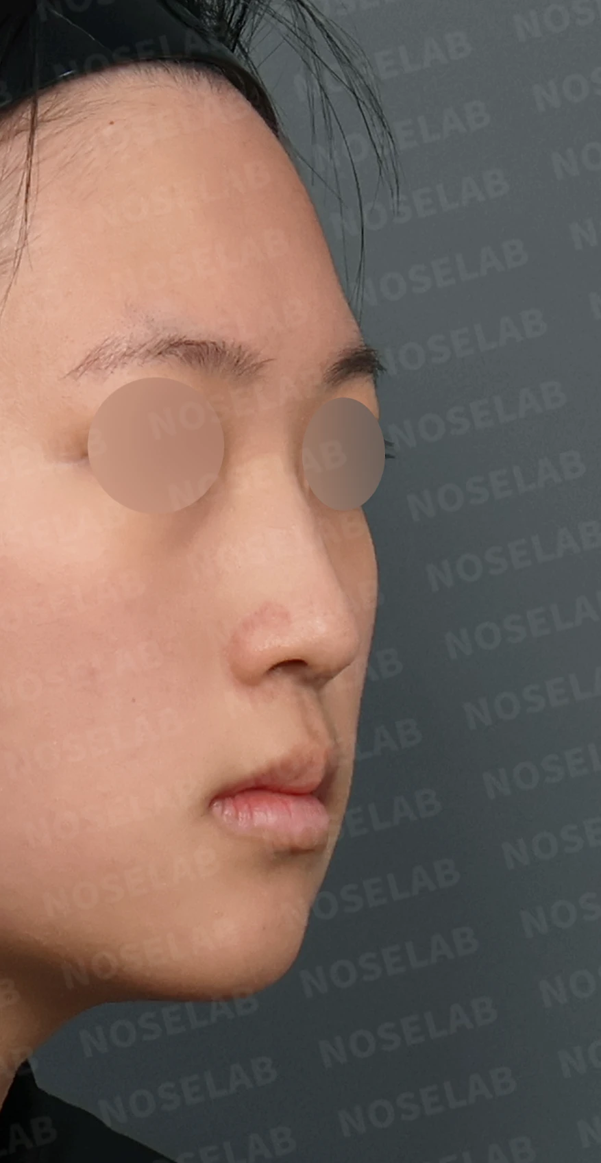 작은 콧날개 연골과 처진 코끝, 자가늑연골과 외측절골술로 자연스럽게 교정 — 디자인 상담 우측 측면, 비스듬한 측면, 비공 사진입니다.